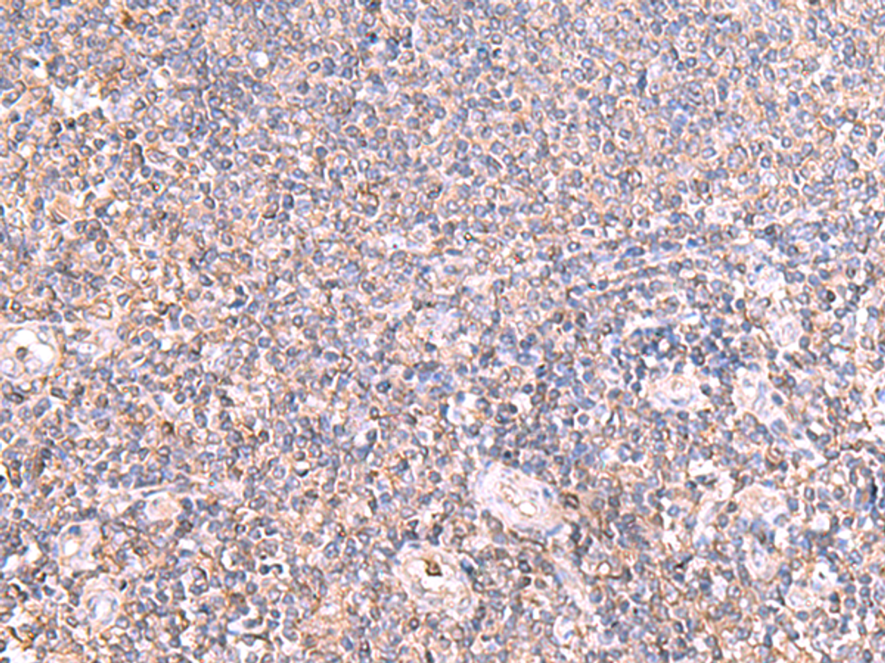 Immunohistochemistry of paraffin-embedded Human tonsil tissue  using IFT57 Polyclonal Antibody at dilution of 1:85(×200)
