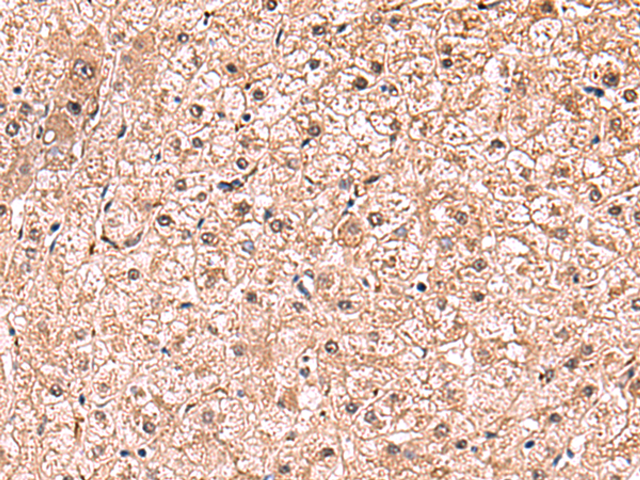 Immunohistochemistry of paraffin-embedded Human liver cancer tissue  using RUSC1 Polyclonal Antibody at dilution of 1:90(×200)