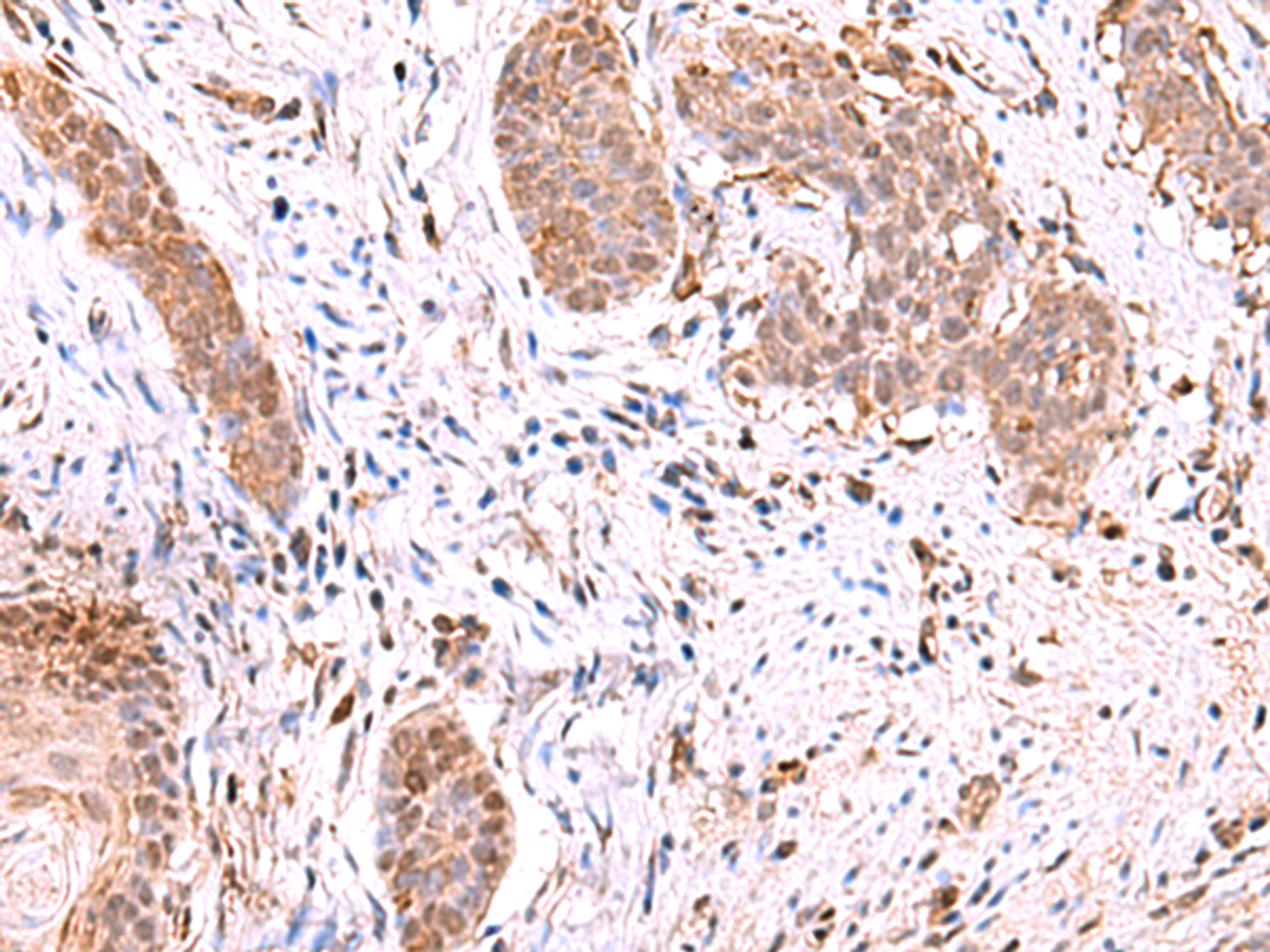 Immunohistochemistry of paraffin-embedded Human esophagus cancer tissue  using RUSC1 Polyclonal Antibody at dilution of 1:90(×200)