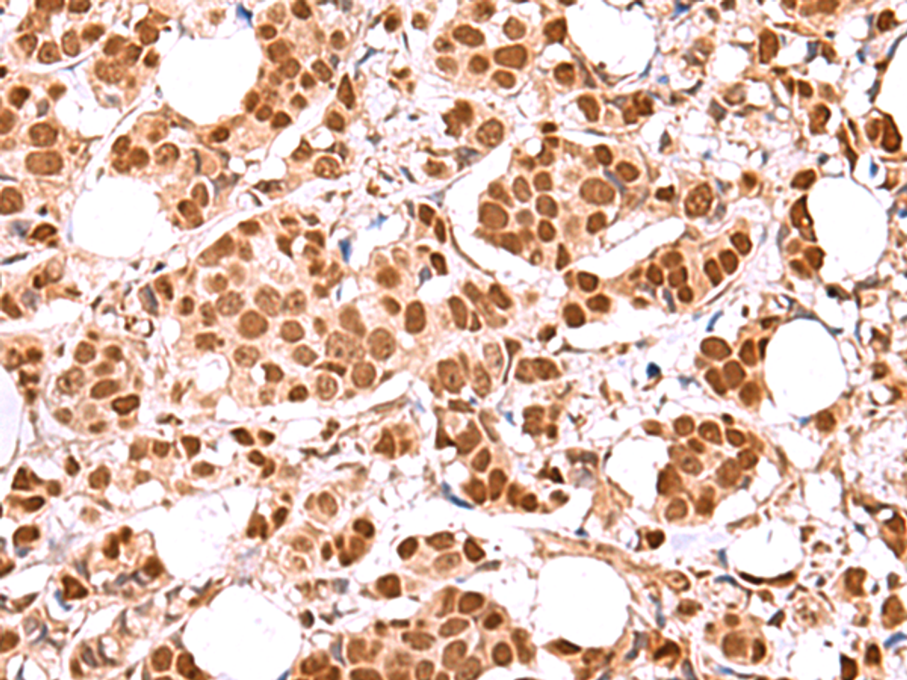 Immunohistochemistry of paraffin-embedded Human breast cancer tissue  using RCOR3 Polyclonal Antibody at dilution of 1:60(×200)