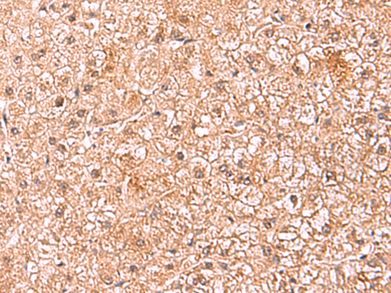 Immunohistochemistry of paraffin-embedded Human liver cancer tissue  using ASTN2 Polyclonal Antibody at dilution of 1:80(×200)