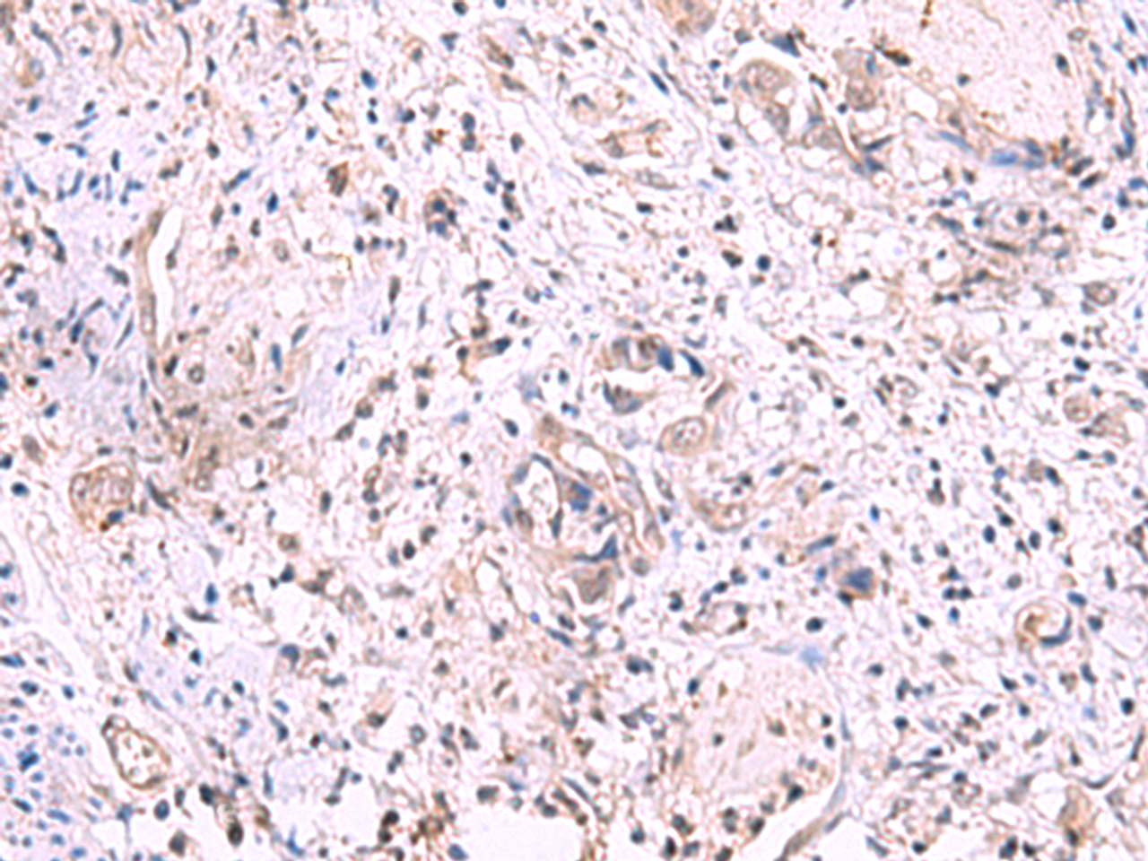 Immunohistochemistry of paraffin-embedded Human cervical cancer tissue  using KIR3DL1 Polyclonal Antibody at dilution of 1:95(×200)