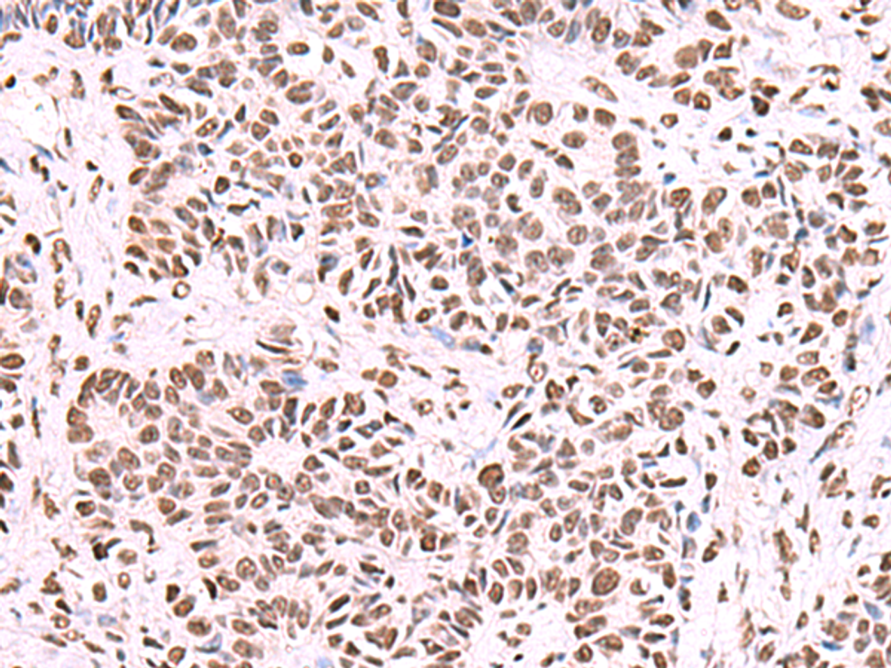 Immunohistochemistry of paraffin-embedded Human ovarian cancer tissue  using NASP Polyclonal Antibody at dilution of 1:55(×200)