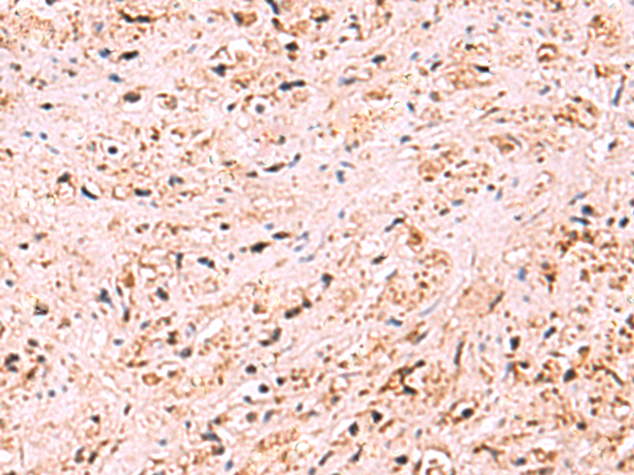 Immunohistochemistry of paraffin-embedded Human prost at e cancer tissue  using ZSWIM1 Polyclonal Antibody at dilution of 1:95(×200)