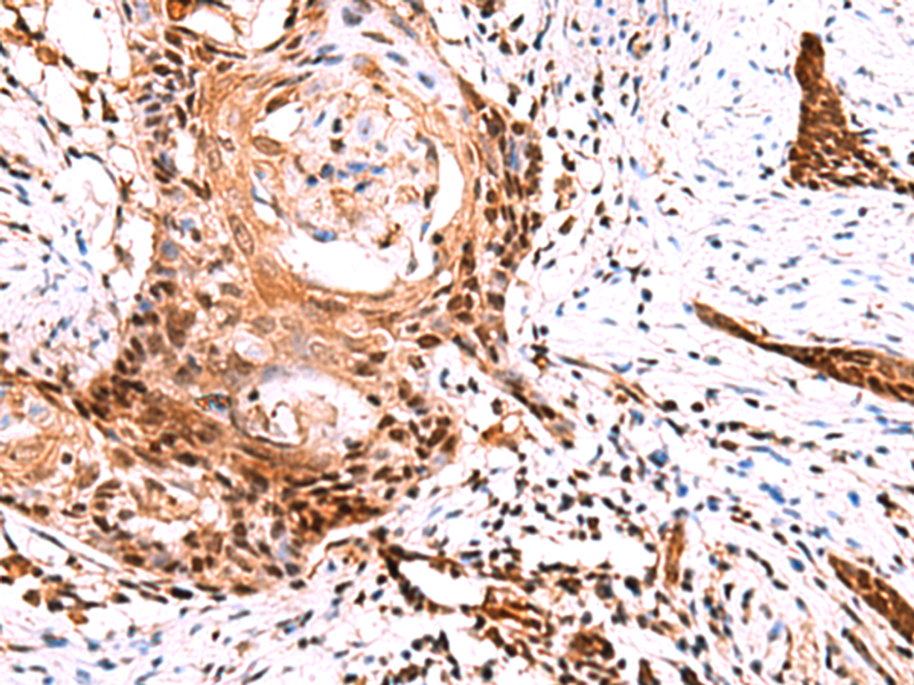 Immunohistochemistry of paraffin-embedded Human esophagus cancer tissue  using TSEN2 Polyclonal Antibody at dilution of 1:60(×200)