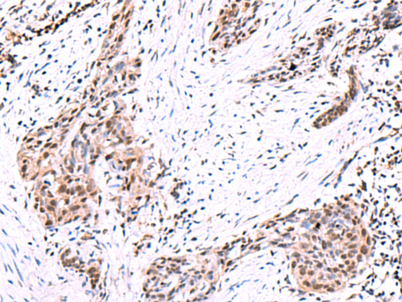 Immunohistochemistry of paraffin-embedded Human esophagus cancer tissue  using POLD2 Polyclonal Antibody at dilution of 1:95(×200)