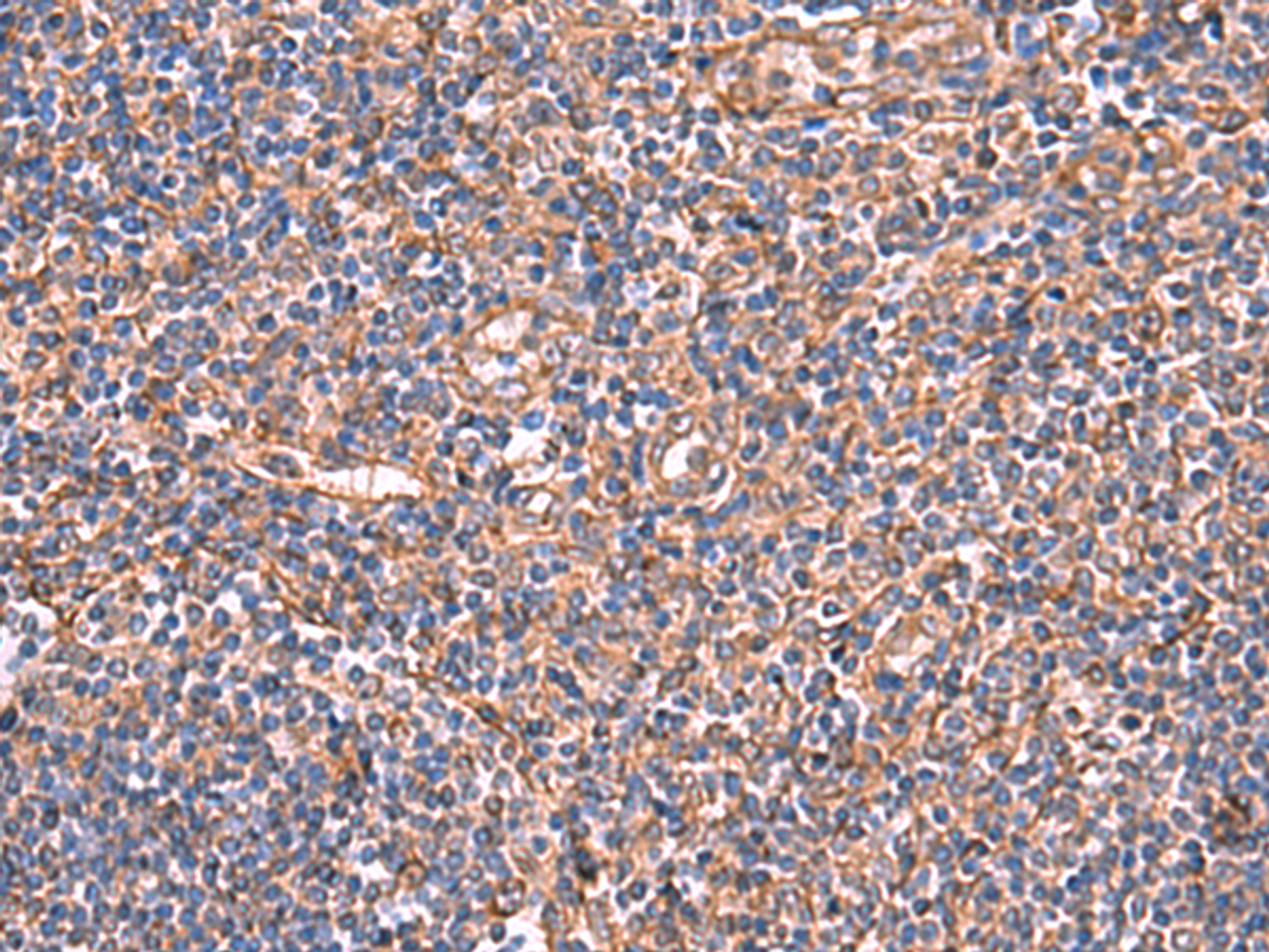 Immunohistochemistry of paraffin-embedded Human tonsil tissue  using TTC38 Polyclonal Antibody at dilution of 1:50(×200)