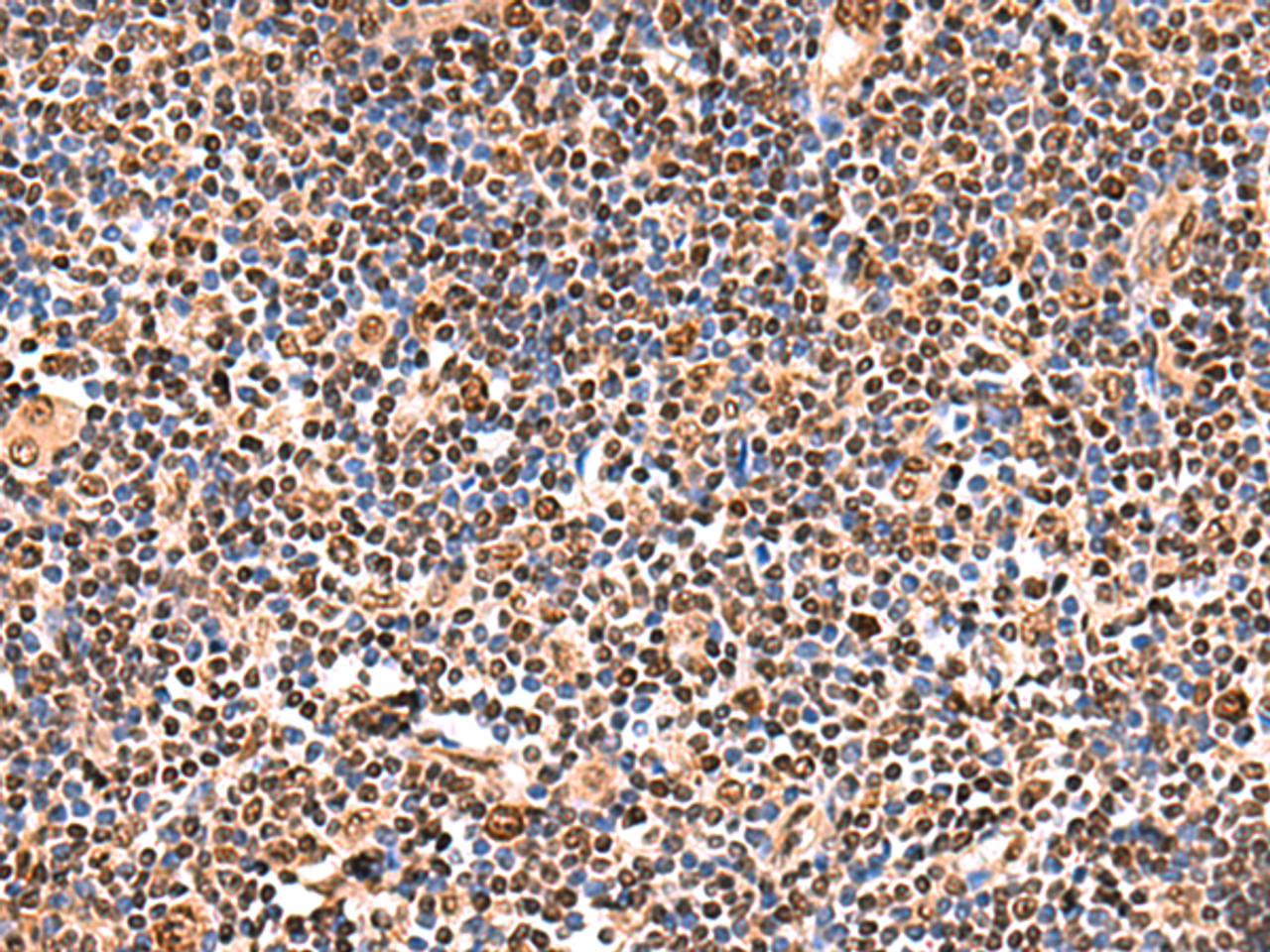 Immunohistochemistry of paraffin-embedded Human tonsil tissue  using GPKOW Polyclonal Antibody at dilution of 1:140(×200)