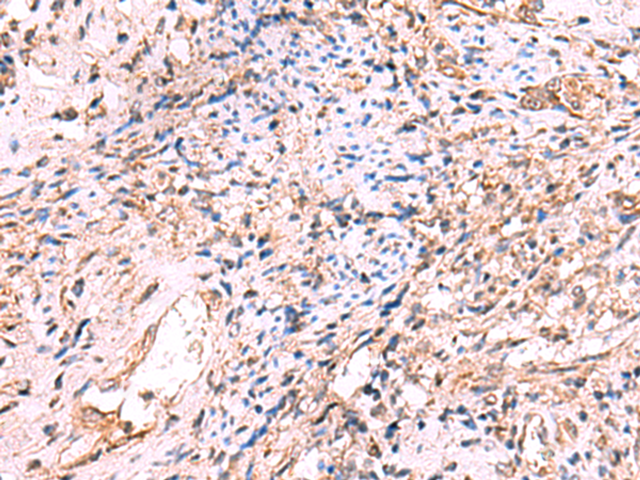 Immunohistochemistry of paraffin-embedded Human cervical cancer tissue  using OSBPL2 Polyclonal Antibody at dilution of 1:55(×200)