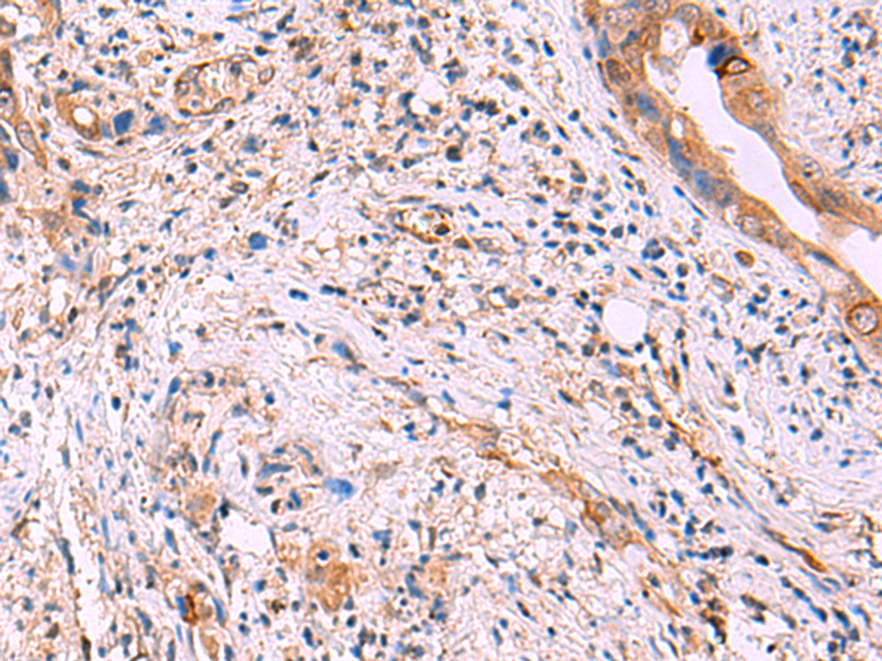 Immunohistochemistry of paraffin-embedded Human cervical cancer tissue  using ZAP70 Polyclonal Antibody at dilution of 1:55(×200)