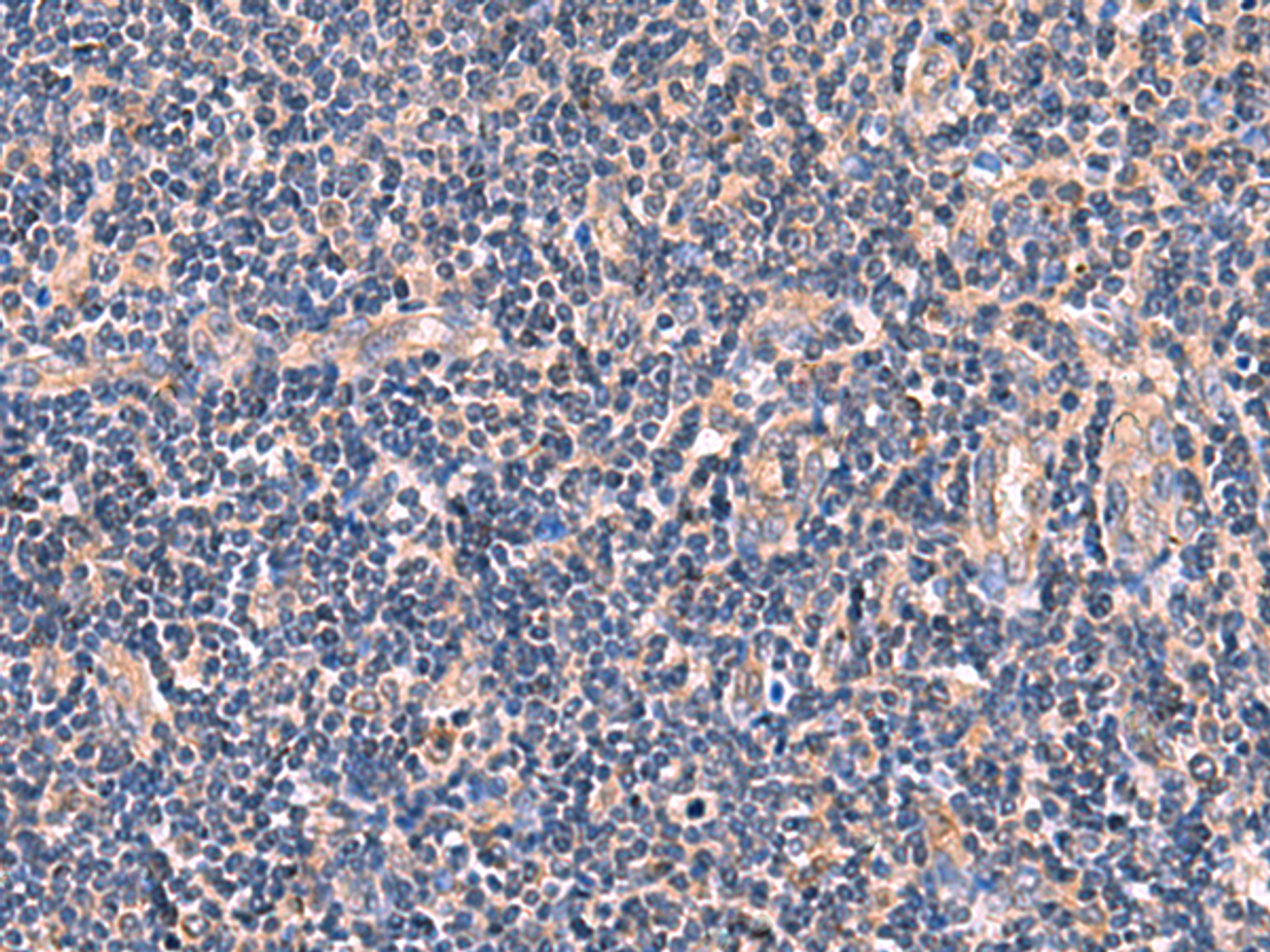 Immunohistochemistry of paraffin-embedded Human tonsil tissue  using MYOT Polyclonal Antibody at dilution of 1:65(×200)