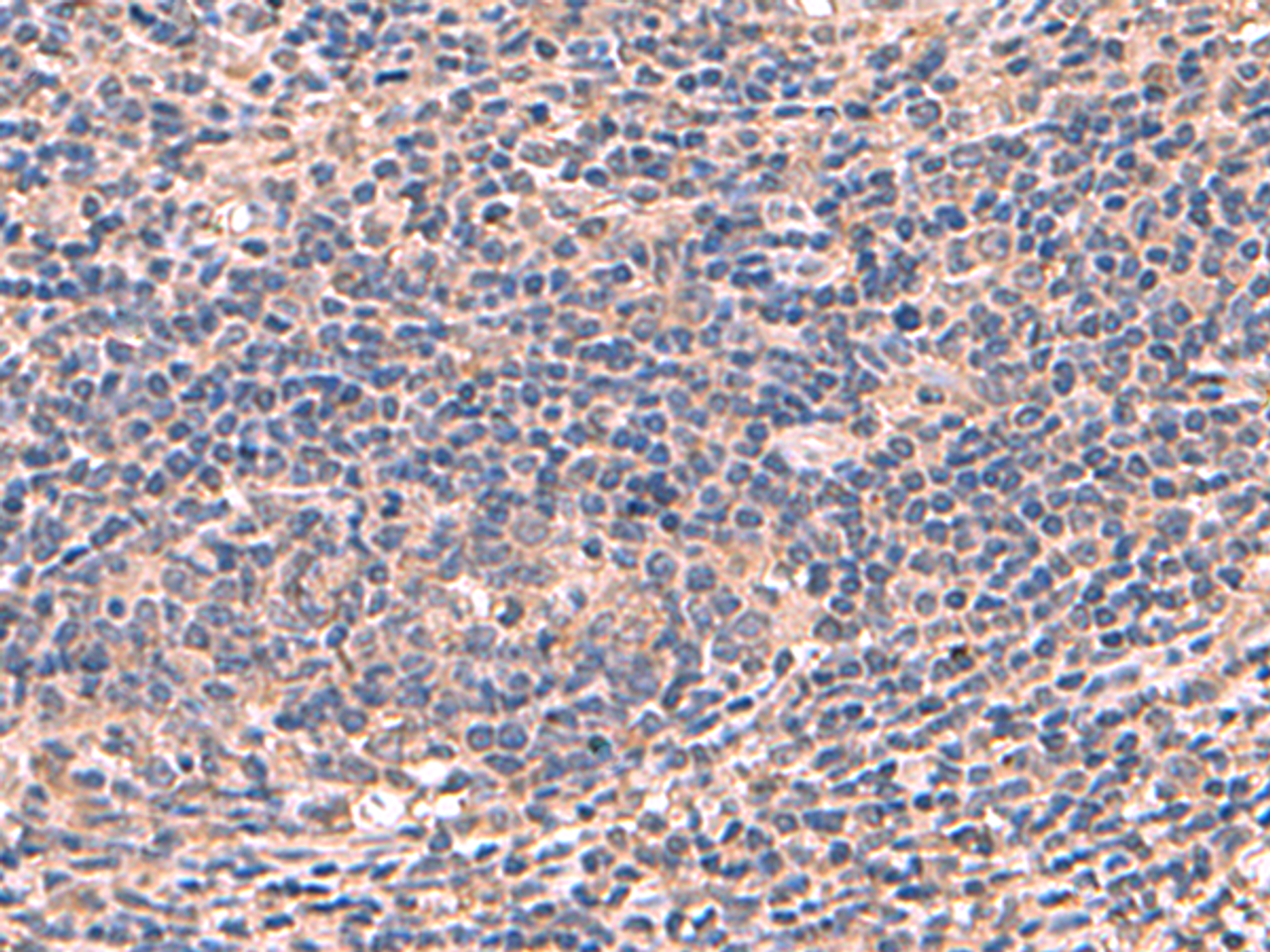 Immunohistochemistry of paraffin-embedded Human cervical cancer tissue  using AHCYL1 Polyclonal Antibody at dilution of 1:70(×200)