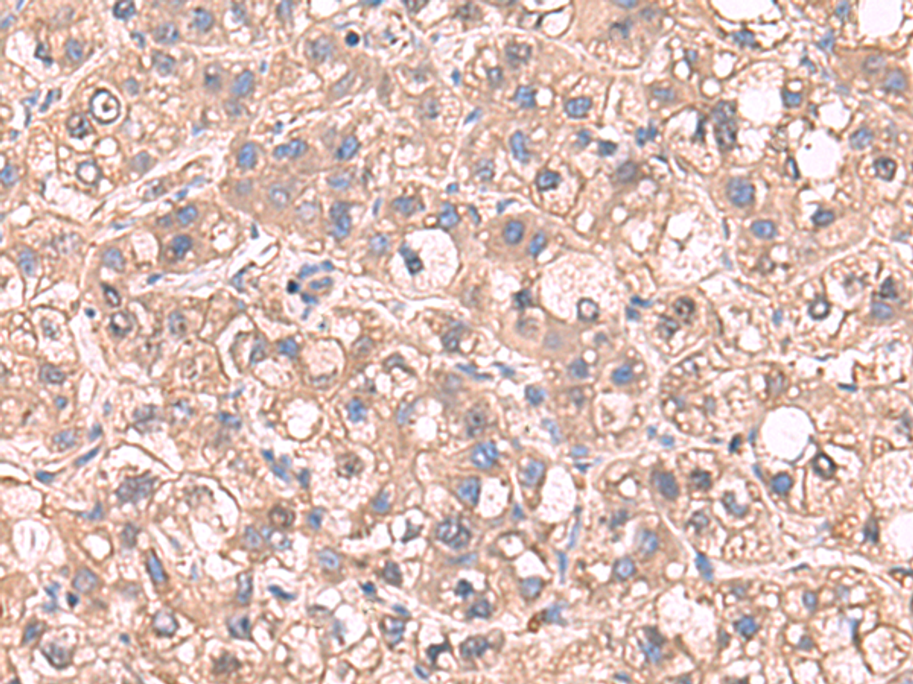 Immunohistochemistry of paraffin-embedded Human liver cancer tissue  using SARS Polyclonal Antibody at dilution of 1:65(×200)