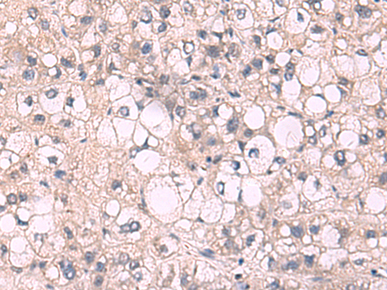 Immunohistochemistry of paraffin-embedded Human liver cancer tissue  using KPNA2 Polyclonal Antibody at dilution of 1:85(×200)