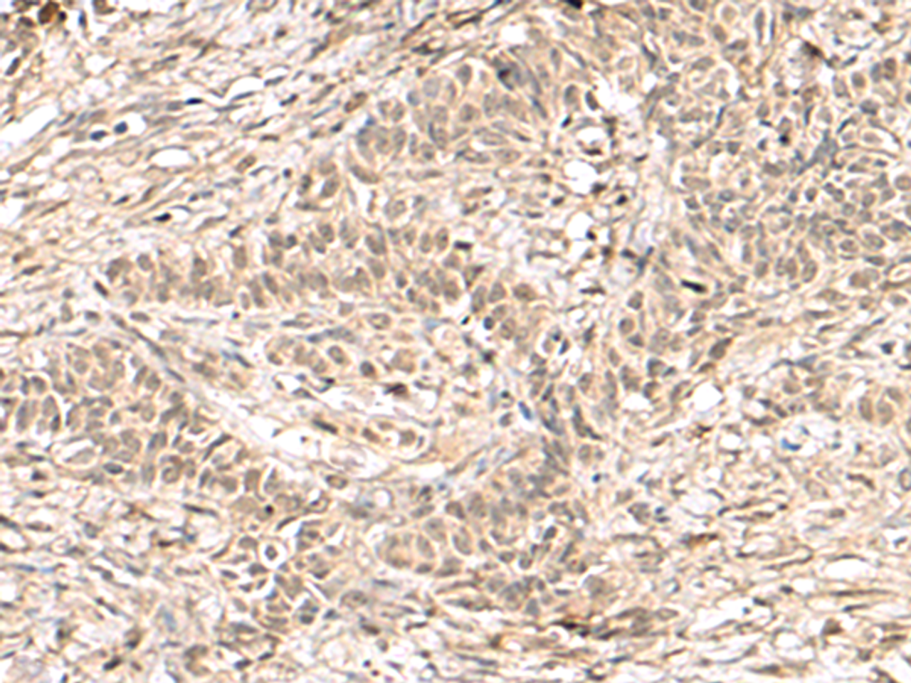 Immunohistochemistry of paraffin-embedded Human ovarian cancer tissue  using RPS6KA5 Polyclonal Antibody at dilution of 1:170(×200)