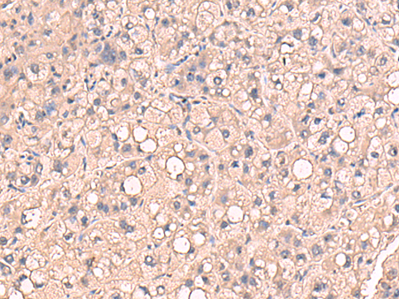 Immunohistochemistry of paraffin-embedded Human liver cancer tissue  using RIOK1 Polyclonal Antibody at dilution of 1:80(×200)
