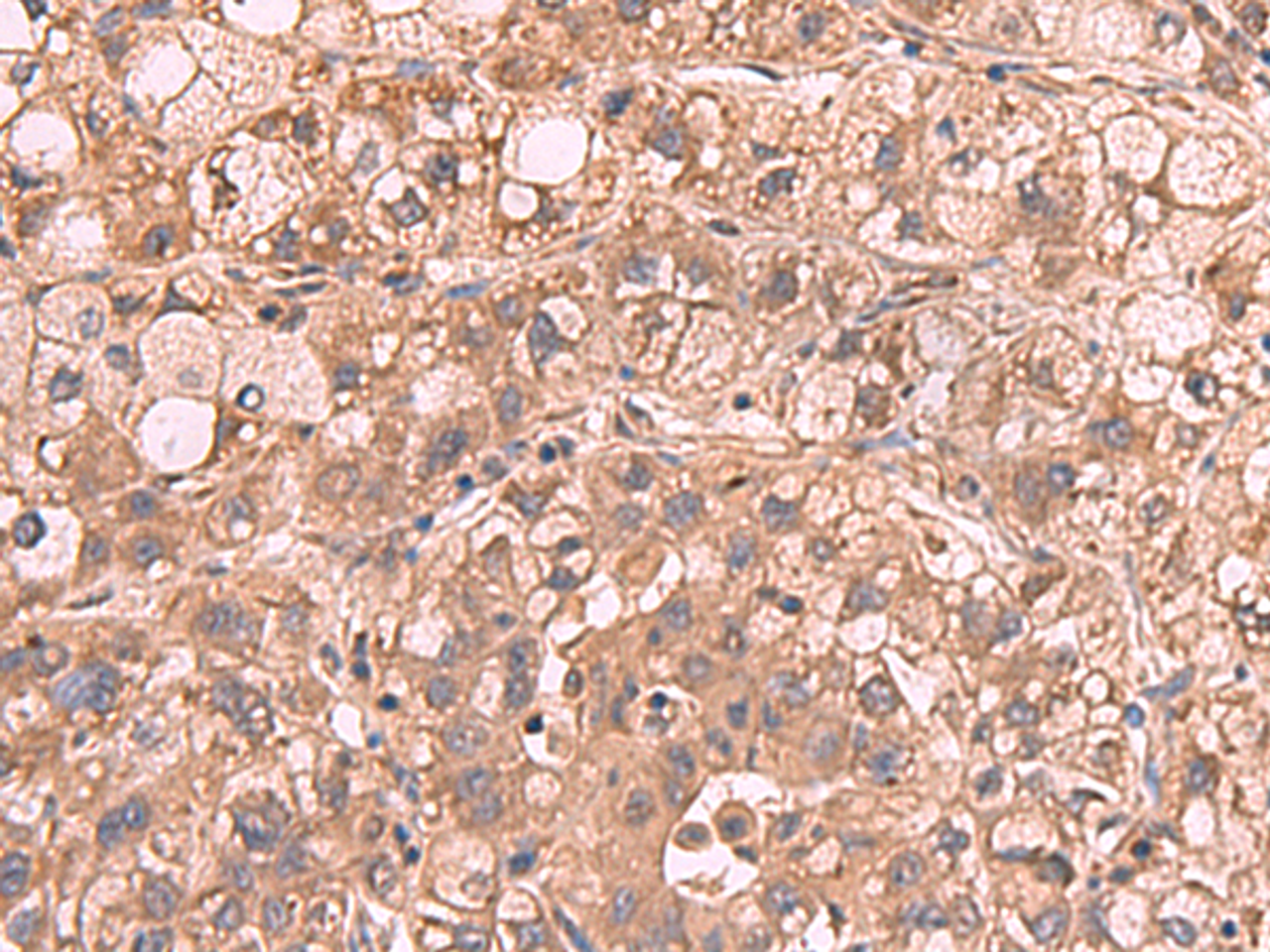 Immunohistochemistry of paraffin-embedded Human liver cancer tissue  using PPP2R1A Polyclonal Antibody at dilution of 1:65(×200)
