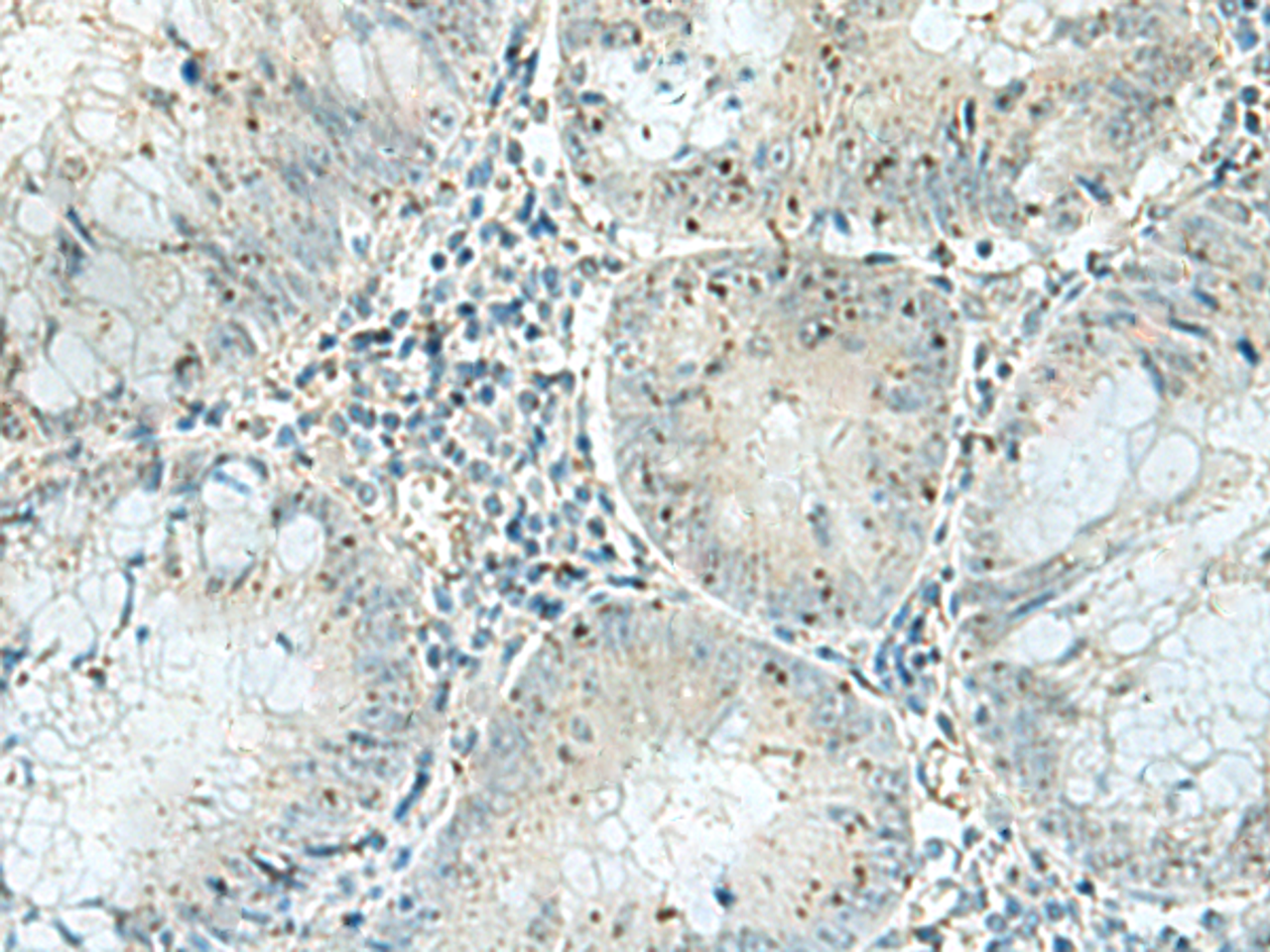 Immunohistochemistry of paraffin-embedded Human colorectal cancer tissue  using PAK1IP1 Polyclonal Antibody at dilution of 1:120(×200)