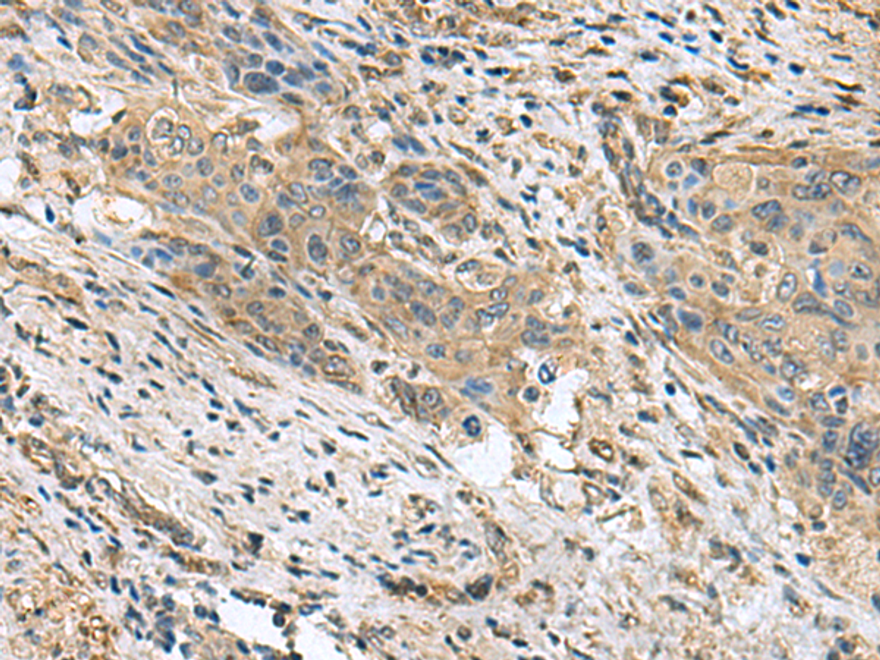 Immunohistochemistry of paraffin-embedded Human cervical cancer tissue  using PAPSS2 Polyclonal Antibody at dilution of 1:60(×200)