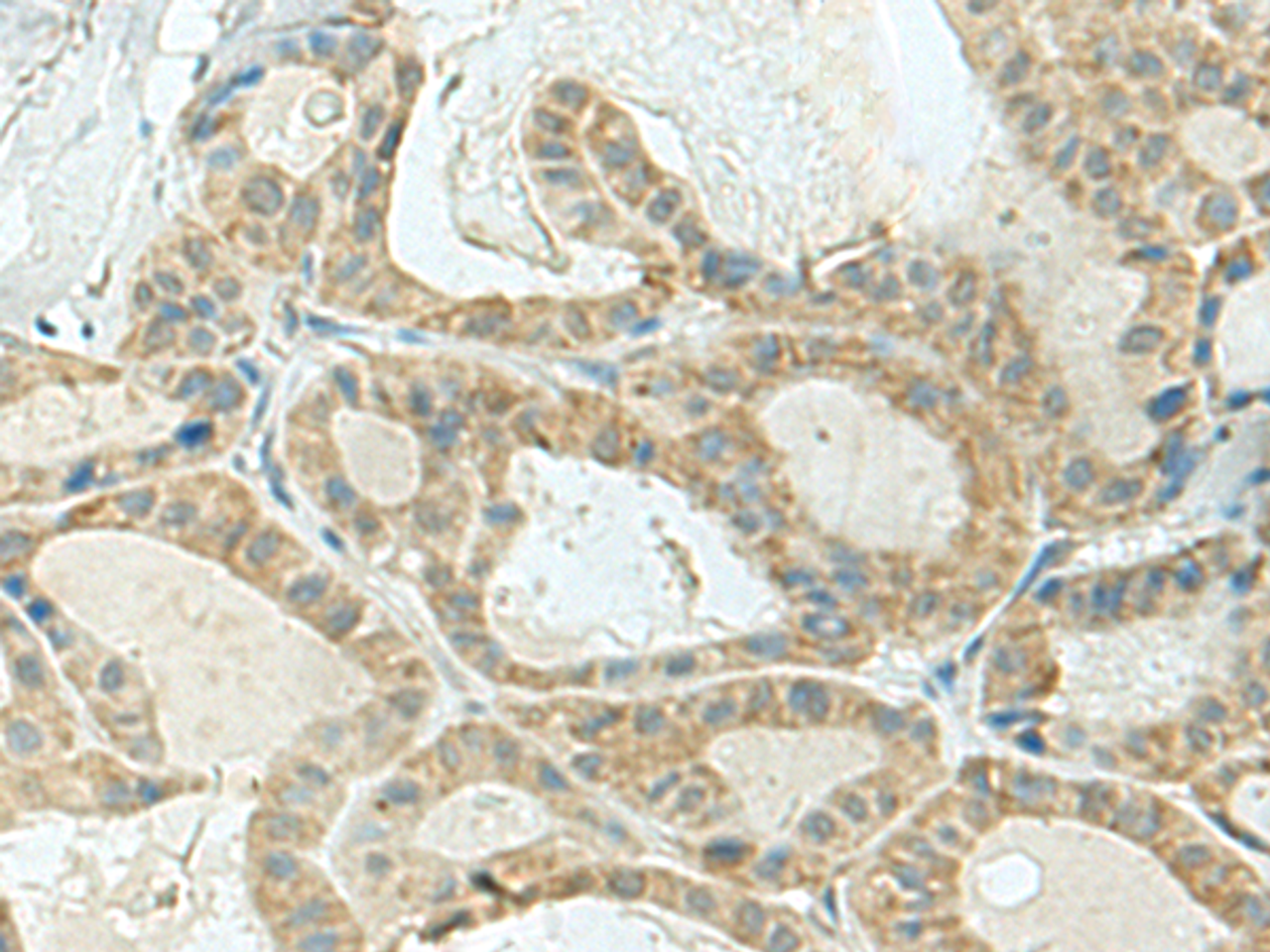 Immunohistochemistry of paraffin-embedded Human thyroid cancer tissue  using KLC2 Polyclonal Antibody at dilution of 1:120(×200)