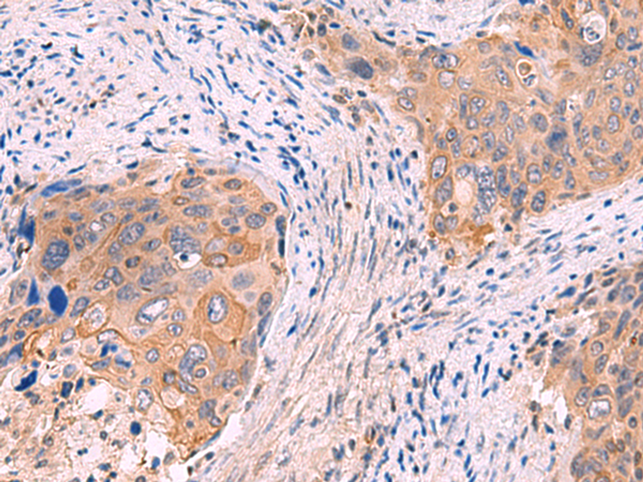 Immunohistochemistry of paraffin-embedded Human cervical cancer tissue  using GSPT2 Polyclonal Antibody at dilution of 1:50(×200)