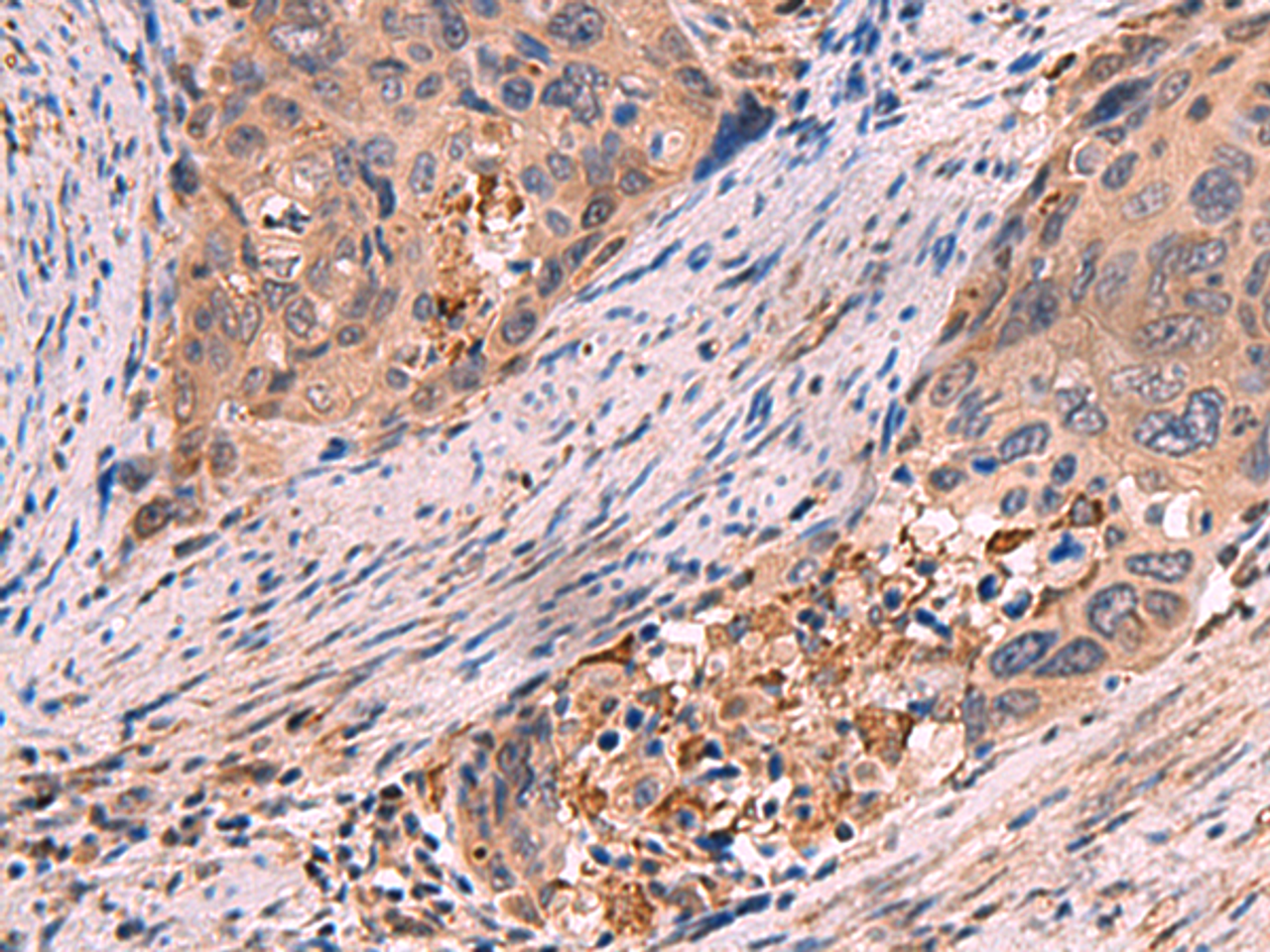Immunohistochemistry of paraffin-embedded Human cervical cancer tissue  using SHC4 Polyclonal Antibody at dilution of 1:85(×200)