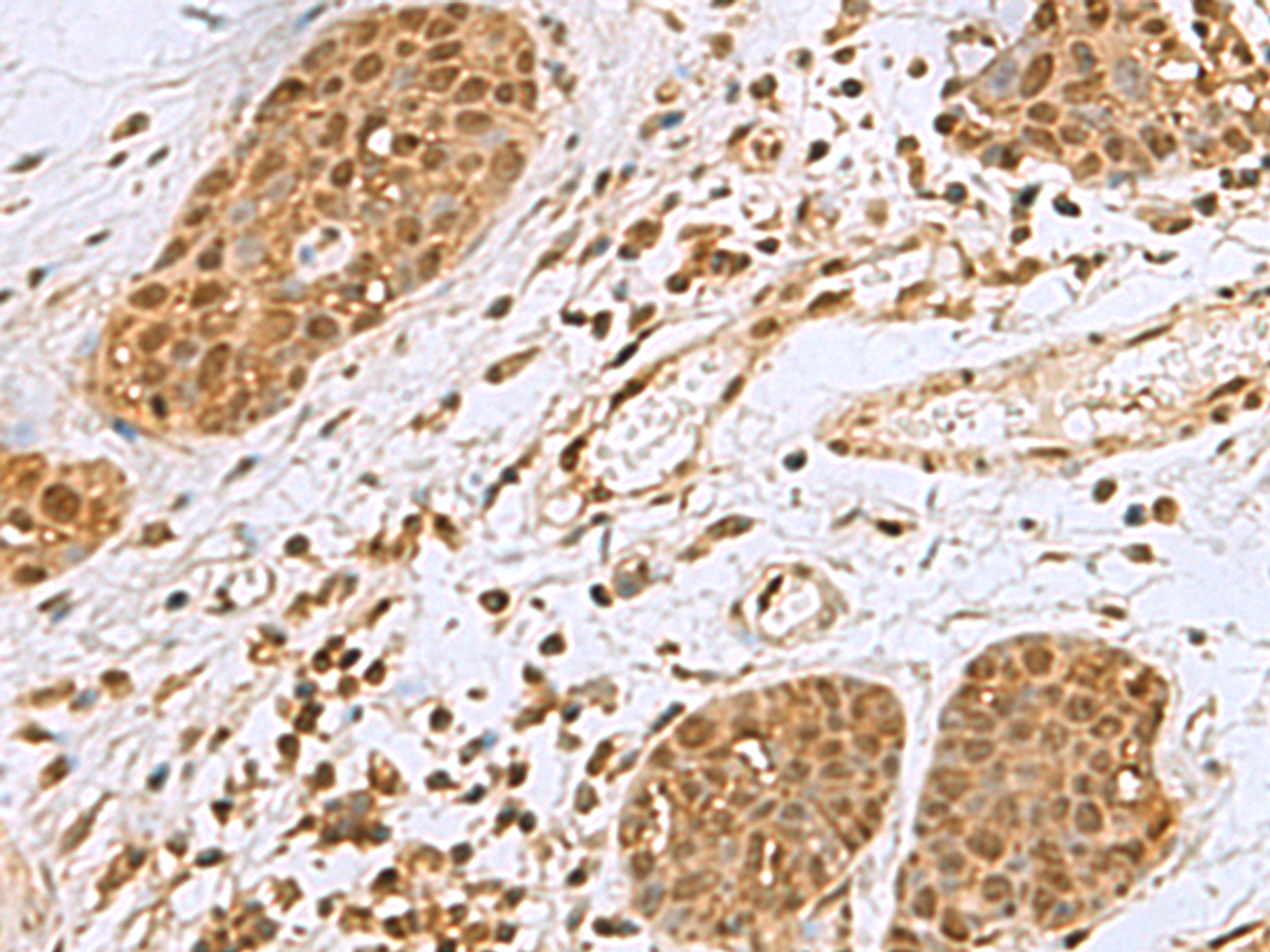 Immunohistochemistry of paraffin-embedded Human esophagus cancer tissue  using NVL Polyclonal Antibody at dilution of 1:80(×200)