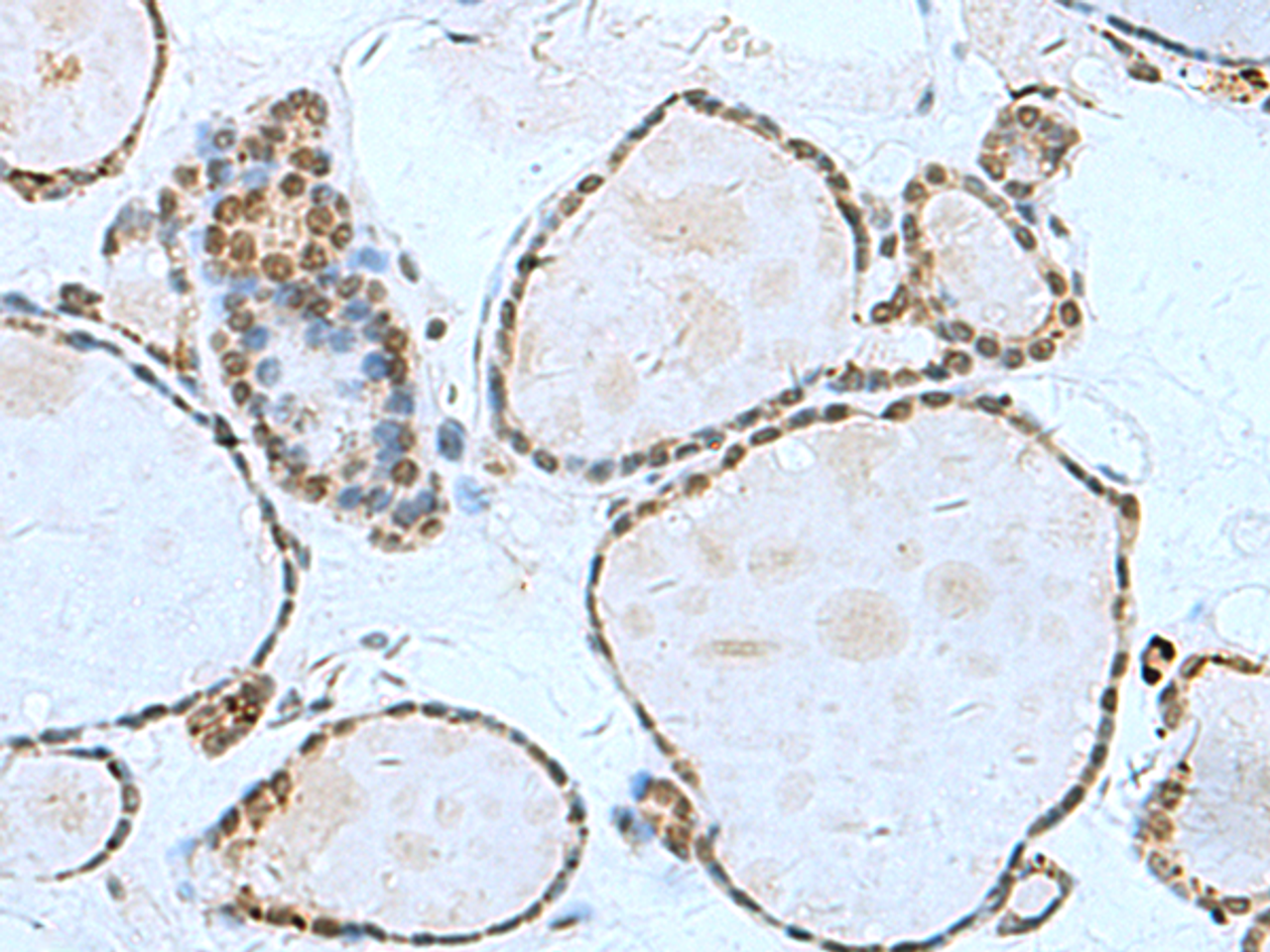 Immunohistochemistry of paraffin-embedded Human thyroid cancer tissue  using L3MBTL2 Polyclonal Antibody at dilution of 1:70(×200)