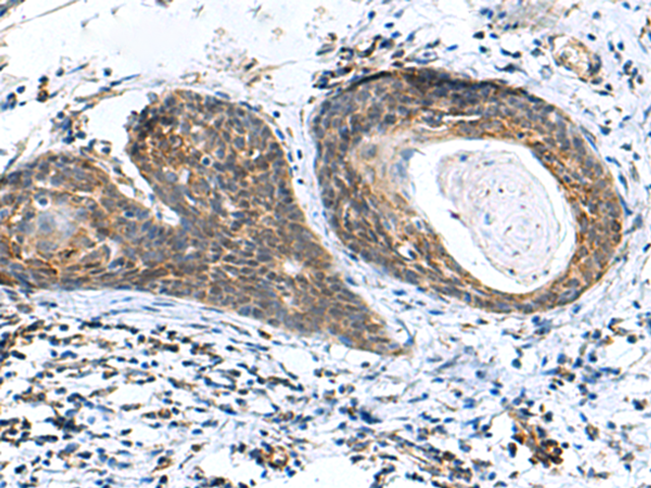 Immunohistochemistry of paraffin-embedded Human esophagus cancer tissue  using AP1S3 Polyclonal Antibody at dilution of 1:70(×200)