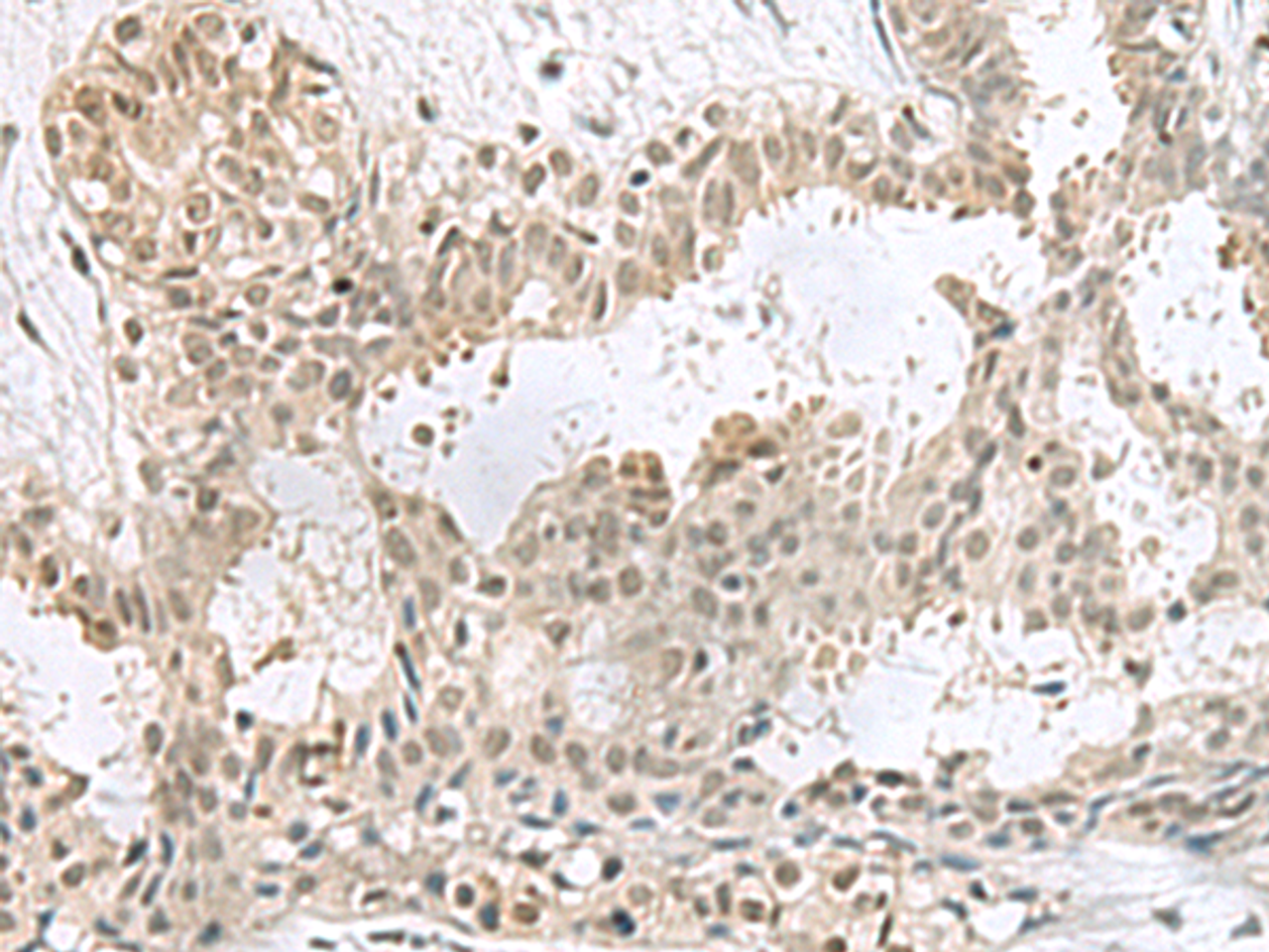 Immunohistochemistry of paraffin-embedded Human breast cancer tissue  using PCBD1 Polyclonal Antibody at dilution of 1:60(×200)