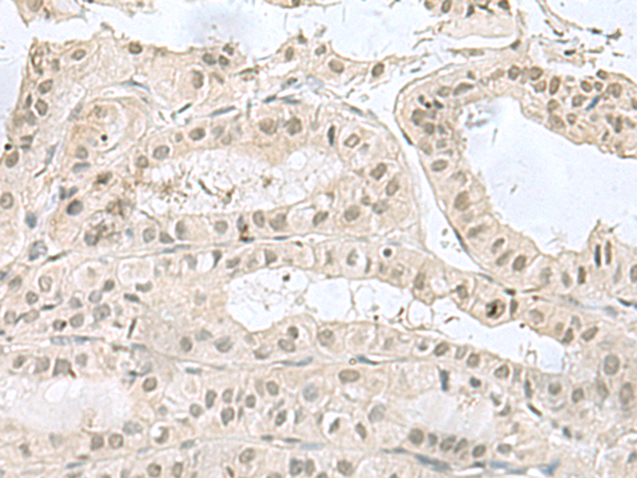 Immunohistochemistry of paraffin-embedded Human thyroid cancer tissue  using PCBD1 Polyclonal Antibody at dilution of 1:60(×200)