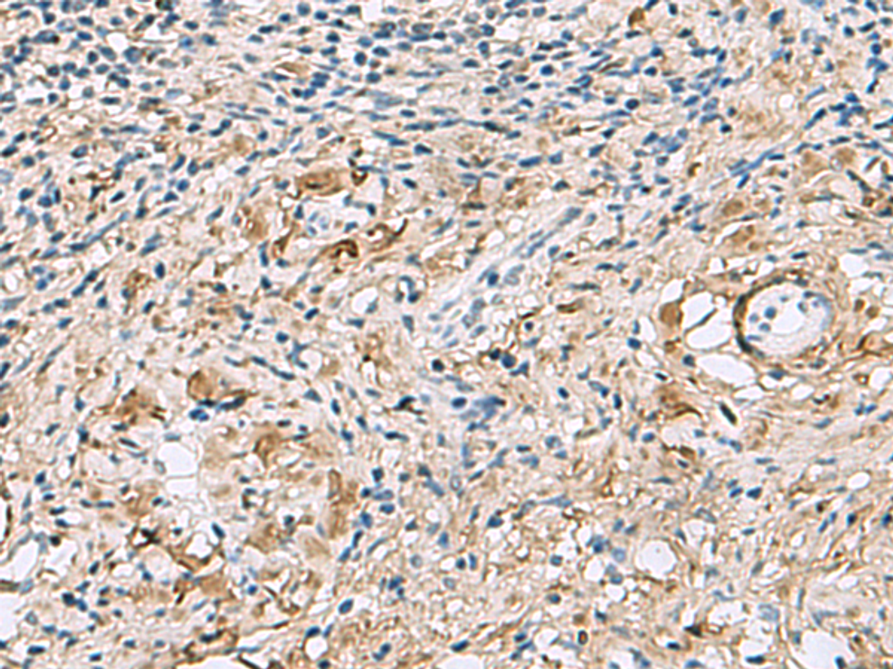 Immunohistochemistry of paraffin-embedded Human cervical cancer tissue  using TMEM141 Polyclonal Antibody at dilution of 1:60(×200)