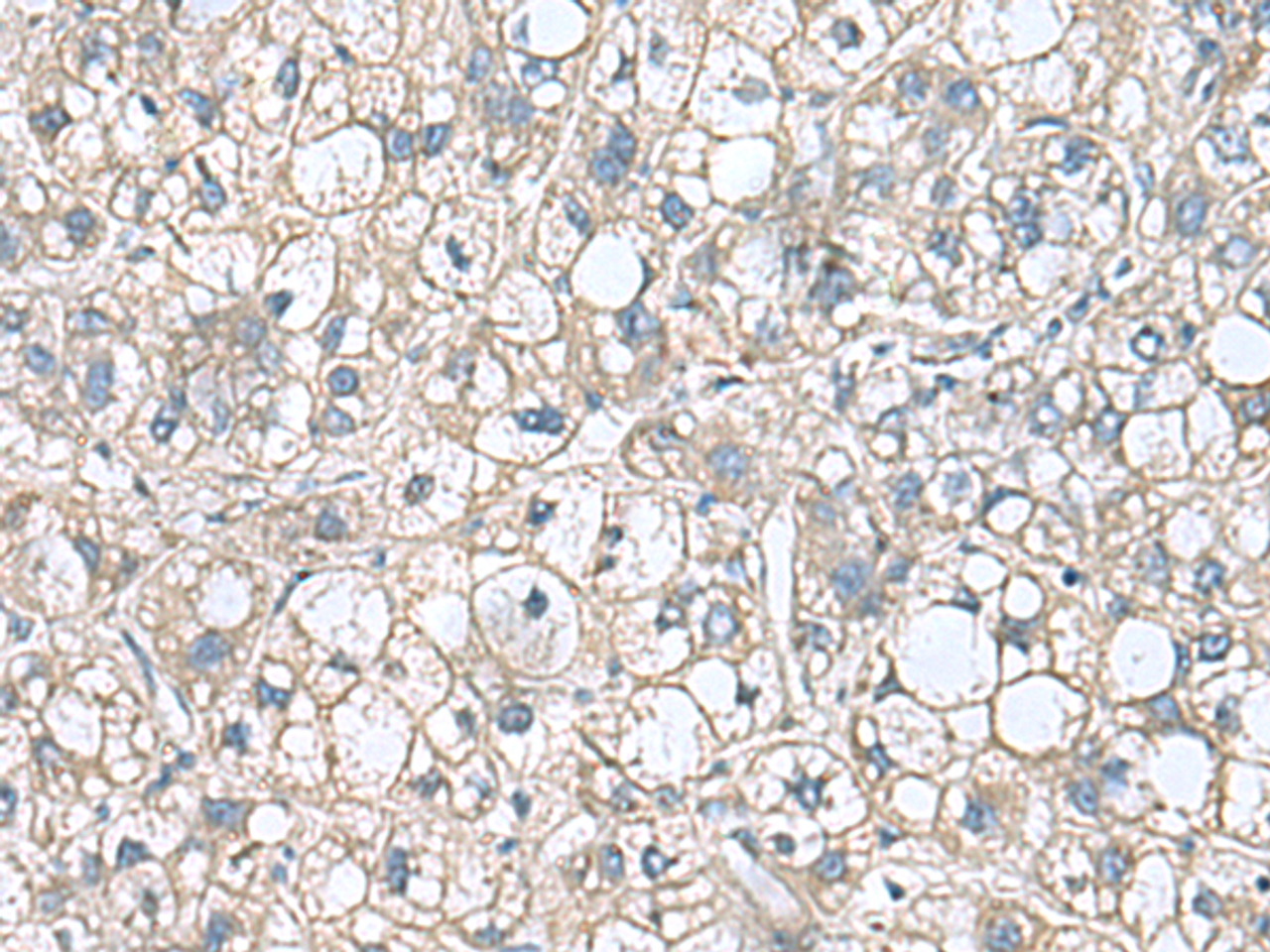 Immunohistochemistry of paraffin-embedded Human liver cancer tissue  using RHBDL2 Polyclonal Antibody at dilution of 1:110(×200)