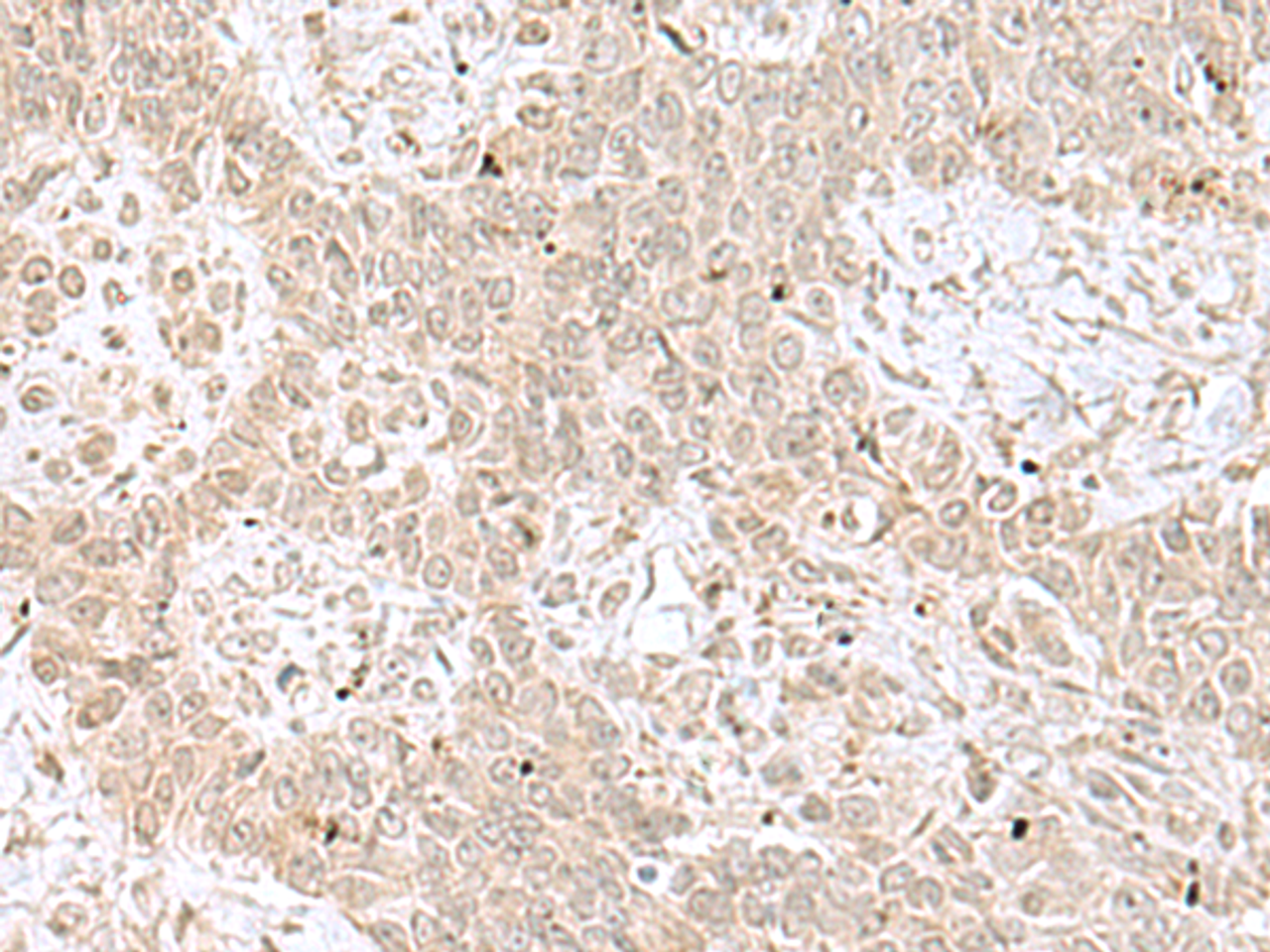 Immunohistochemistry of paraffin-embedded Human ovarian cancer tissue  using RPL35 Polyclonal Antibody at dilution of 1:70(×200)