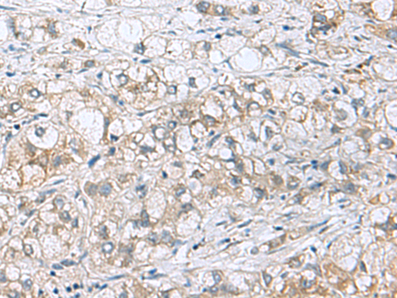 Immunohistochemistry of paraffin-embedded Human liver cancer tissue  using PHPT1 Polyclonal Antibody at dilution of 1:210(×200)