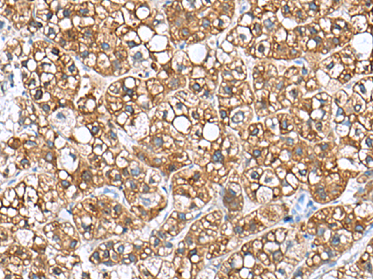 Immunohistochemistry of paraffin-embedded Human liver cancer tissue  using PHLDA3 Polyclonal Antibody at dilution of 1:110(×200)