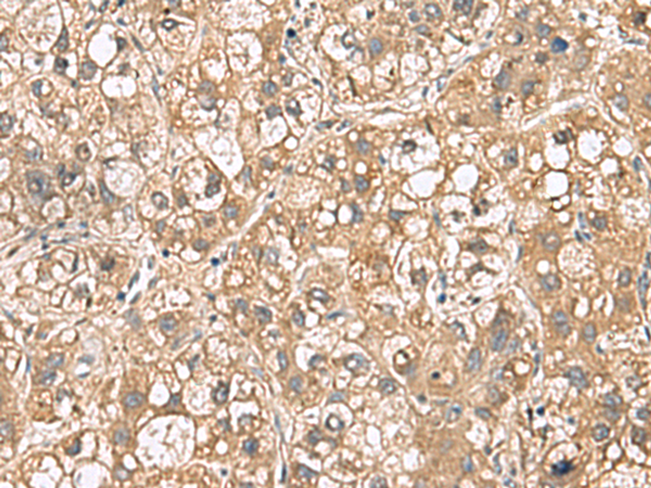 Immunohistochemistry of paraffin-embedded Human liver cancer tissue  using PTPRS Polyclonal Antibody at dilution of 1:110(×200)