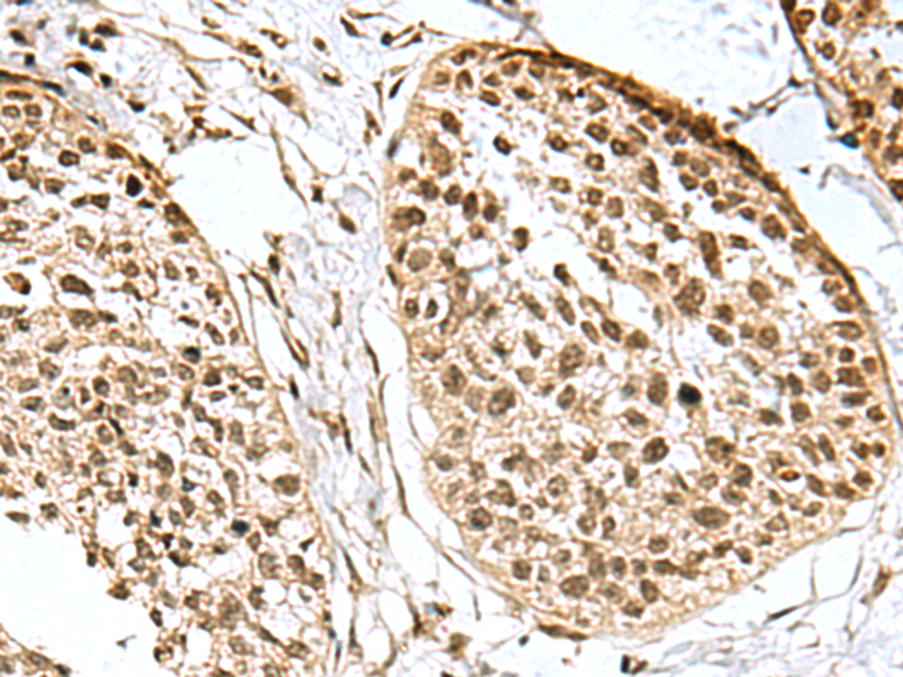 Immunohistochemistry of paraffin-embedded Human esophagus cancer tissue  using H2AFJ Polyclonal Antibody at dilution of 1:170(×200)