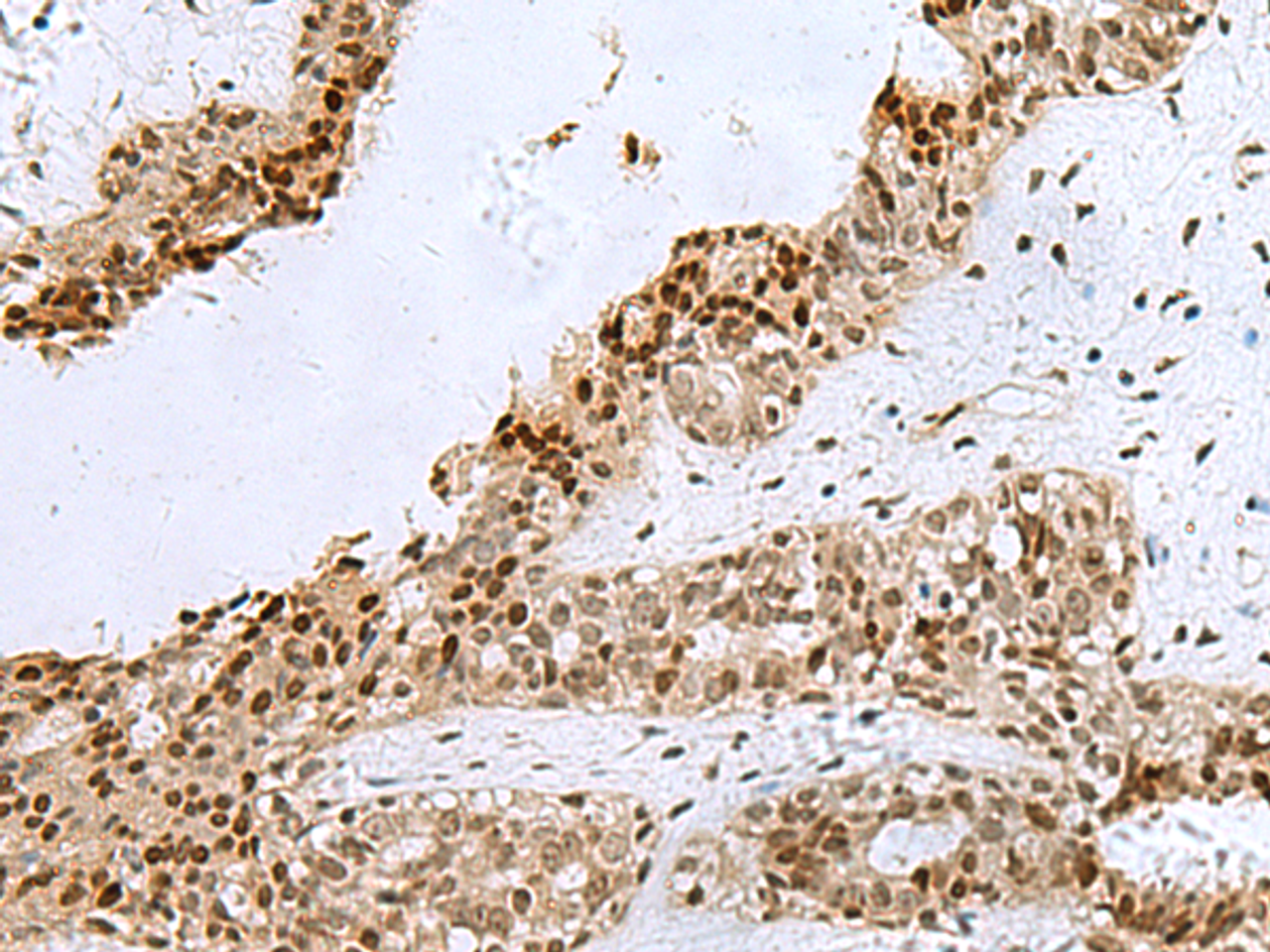 Immunohistochemistry of paraffin-embedded Human breast cancer tissue  using H2AFJ Polyclonal Antibody at dilution of 1:170(×200)