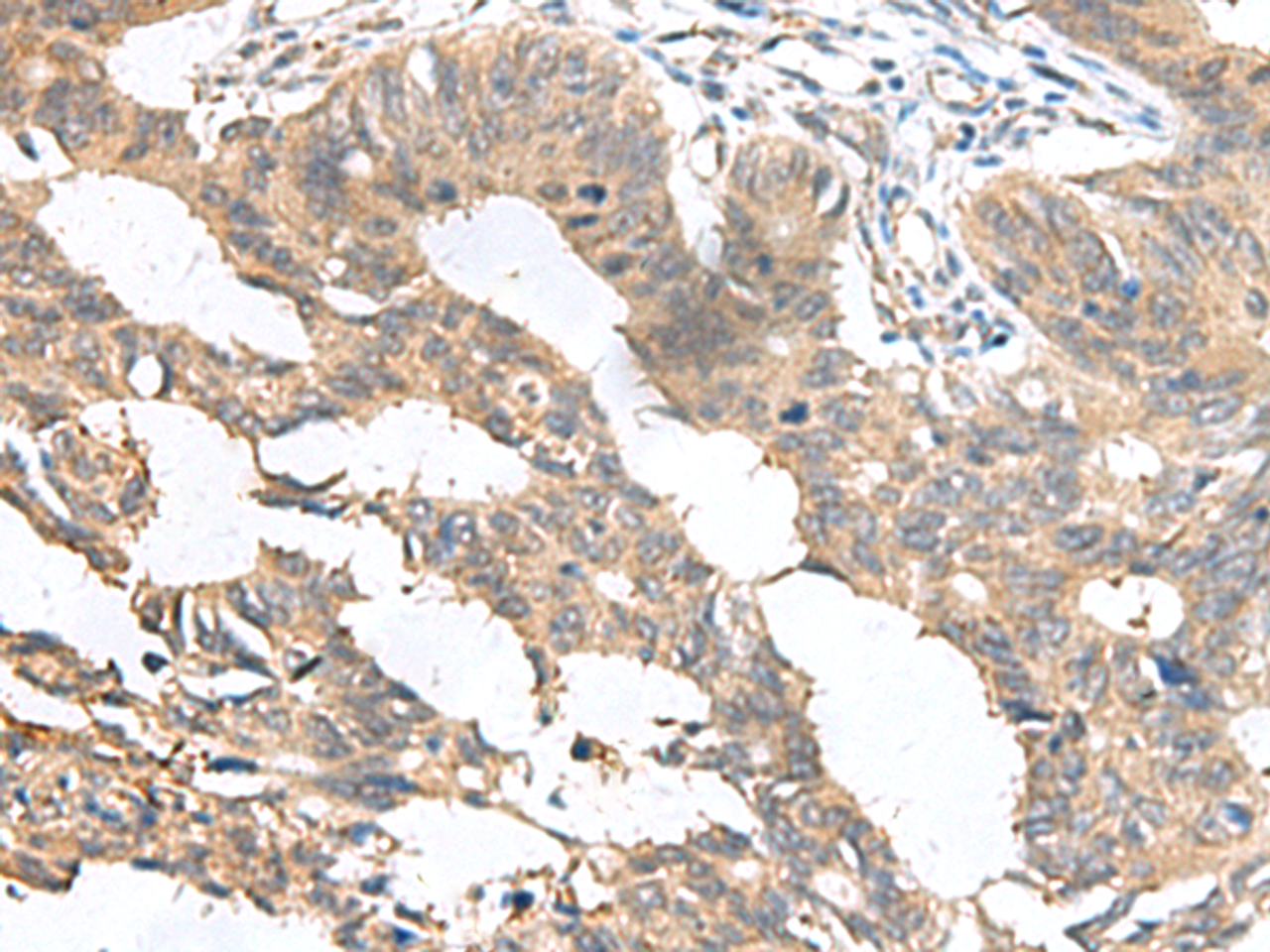 Immunohistochemistry of paraffin-embedded Human colorectal cancer tissue  using MIA Polyclonal Antibody at dilution of 1:100(×200)