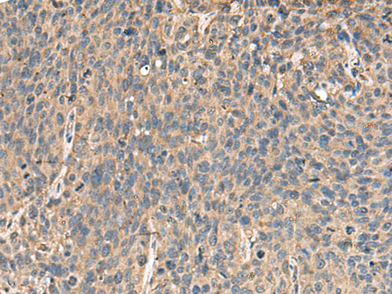 Immunohistochemistry of paraffin-embedded Human cervical cancer tissue  using MRPL42 Polyclonal Antibody at dilution of 1:65(×200)
