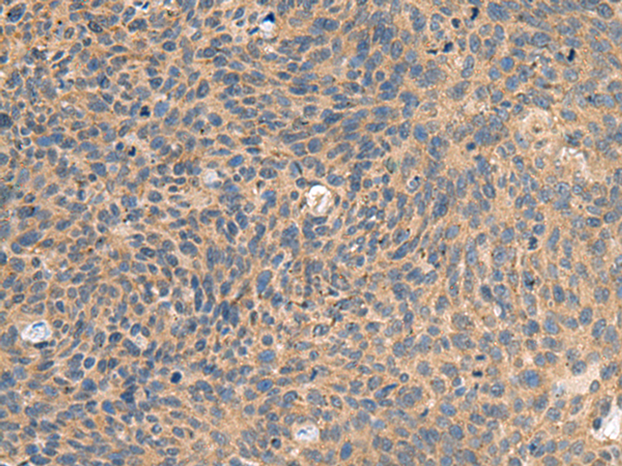 Immunohistochemistry of paraffin-embedded Human cervical cancer tissue  using EIF1AX Polyclonal Antibody at dilution of 1:65(×200)