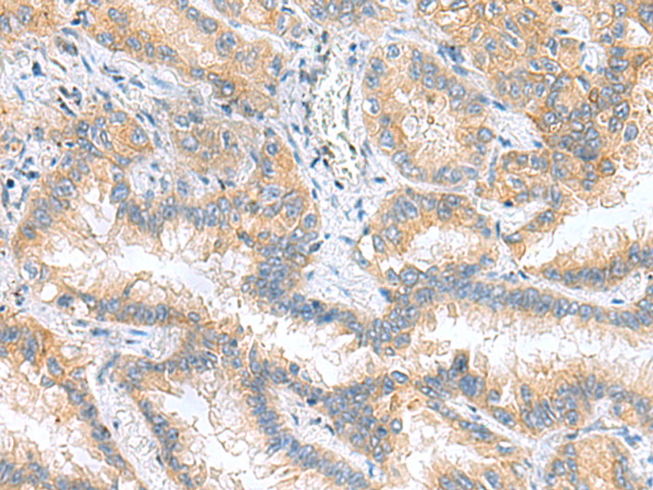 Immunohistochemistry of paraffin-embedded Human lung cancer tissue  using RPS16 Polyclonal Antibody at dilution of 1:60(×200)