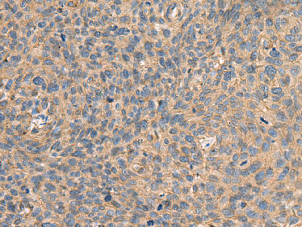 Immunohistochemistry of paraffin-embedded Human cervical cancer tissue  using AHNAK Polyclonal Antibody at dilution of 1:50(×200)
