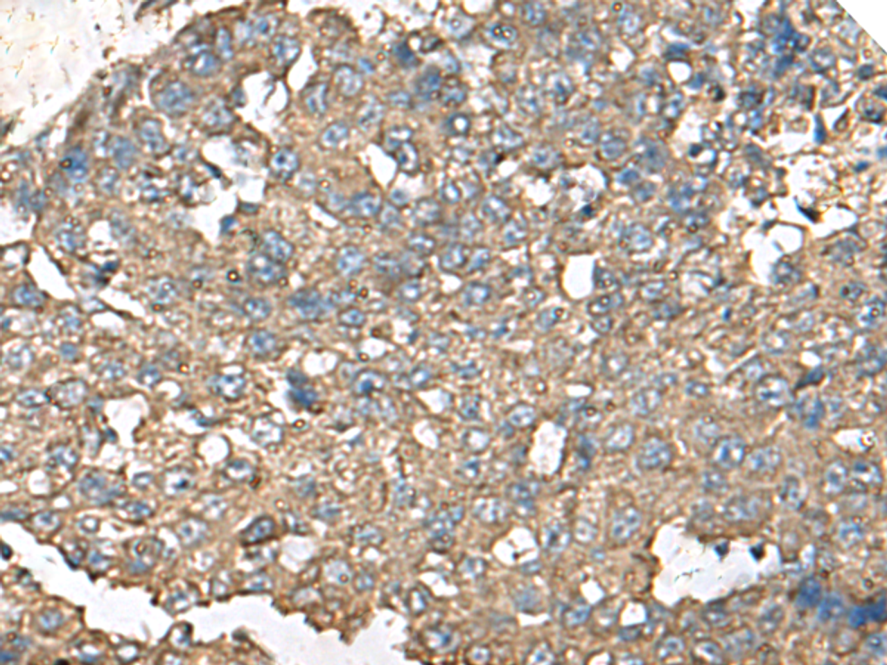 Immunohistochemistry of paraffin-embedded Human liver cancer tissue  using RPS14 Polyclonal Antibody at dilution of 1:50(×200)