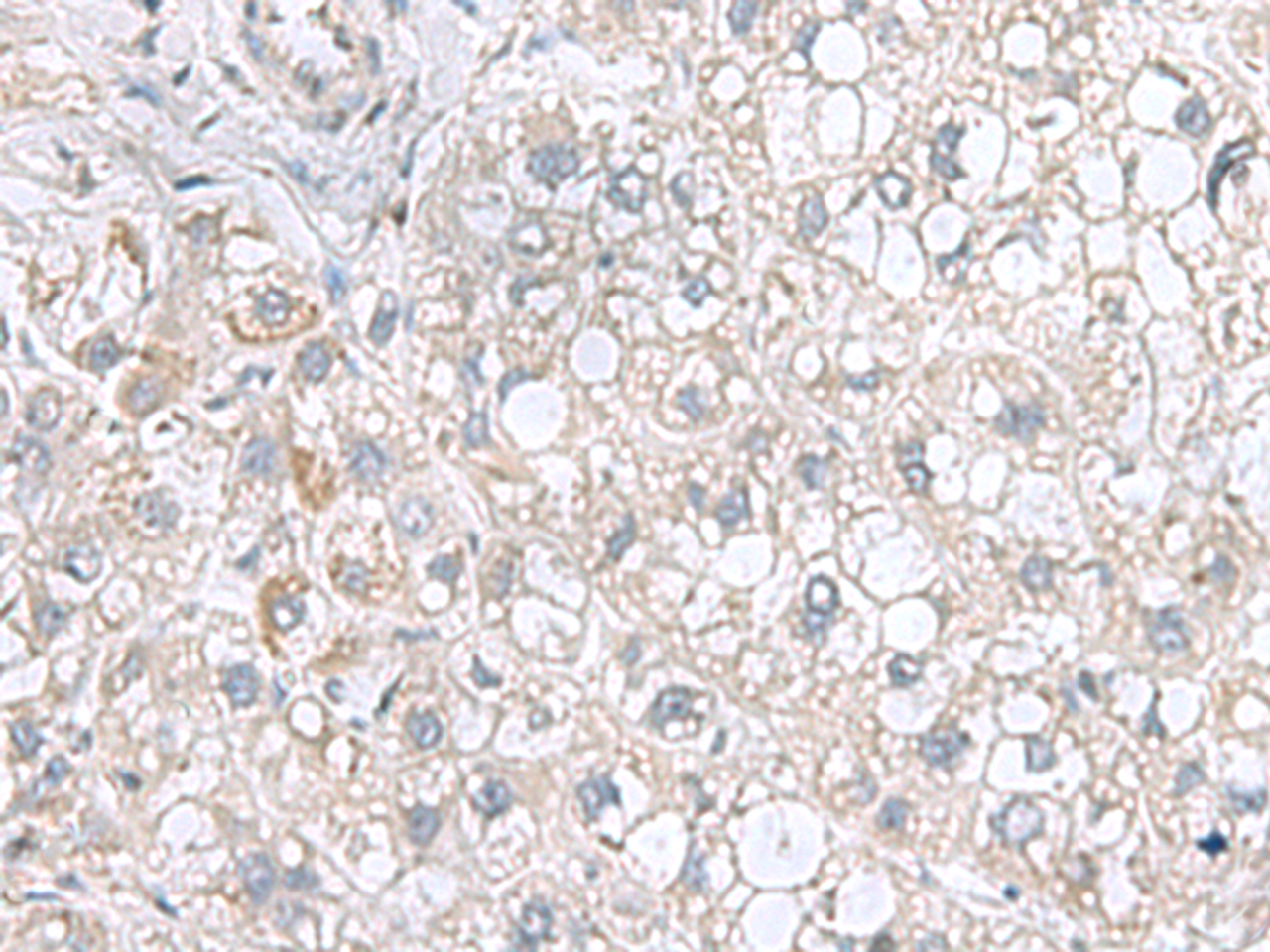 Immunohistochemistry of paraffin-embedded Human liver cancer tissue  using STK32A Polyclonal Antibody at dilution of 1:95(×200)