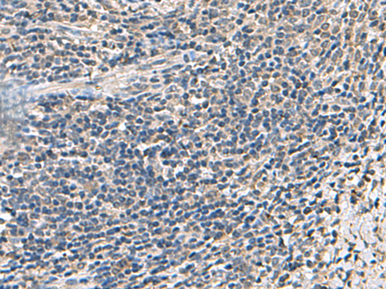 Immunohistochemistry of paraffin-embedded Human cervical cancer tissue  using ATP5F1D Polyclonal Antibody at dilution of 1:55(×200)