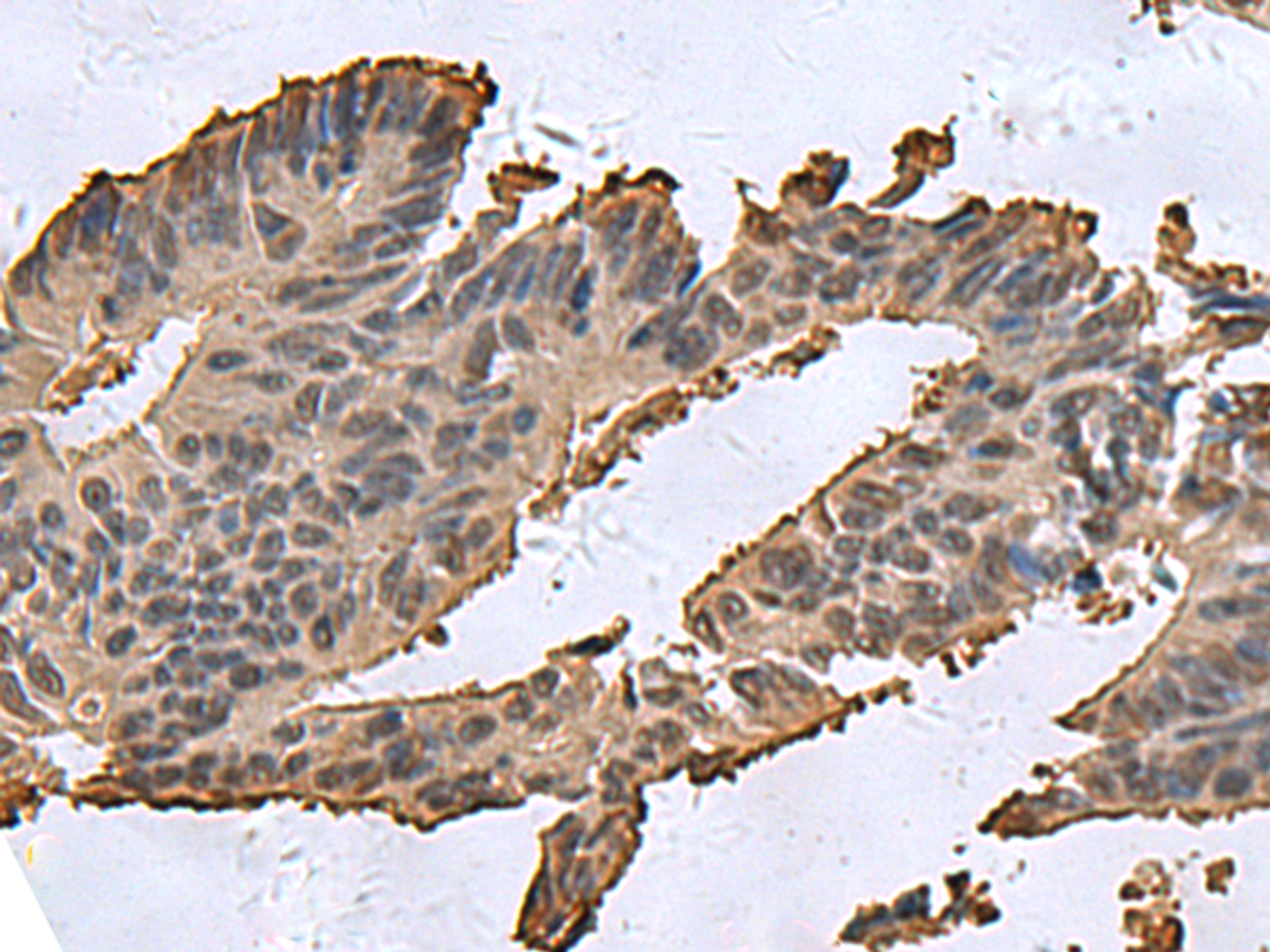 Immunohistochemistry of paraffin-embedded Human colorectal cancer tissue  using DCTPP1 Polyclonal Antibody at dilution of 1:85(×200)