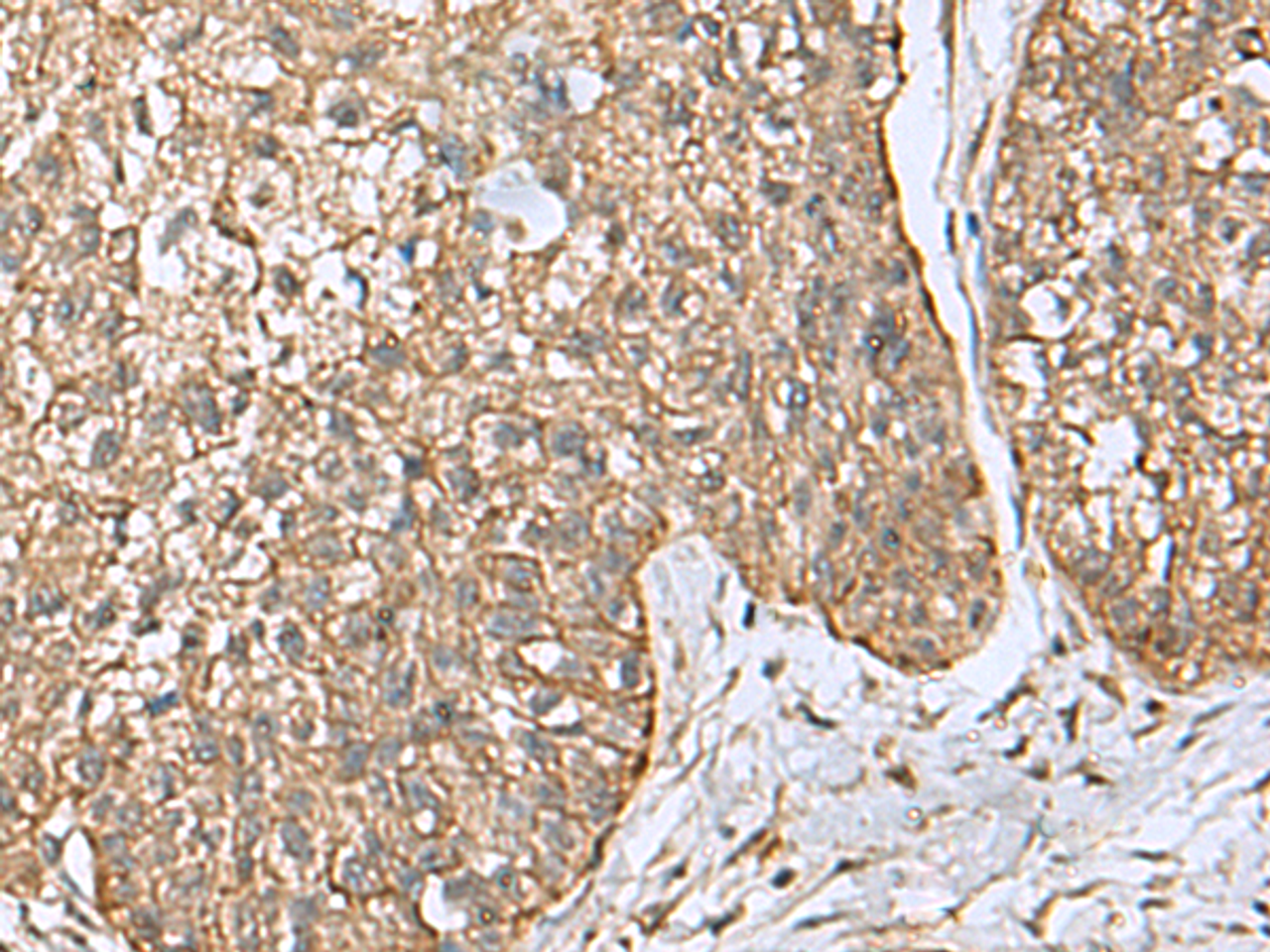Immunohistochemistry of paraffin-embedded Human esophagus cancer tissue  using EIF4A2 Polyclonal Antibody at dilution of 1:65(×200)