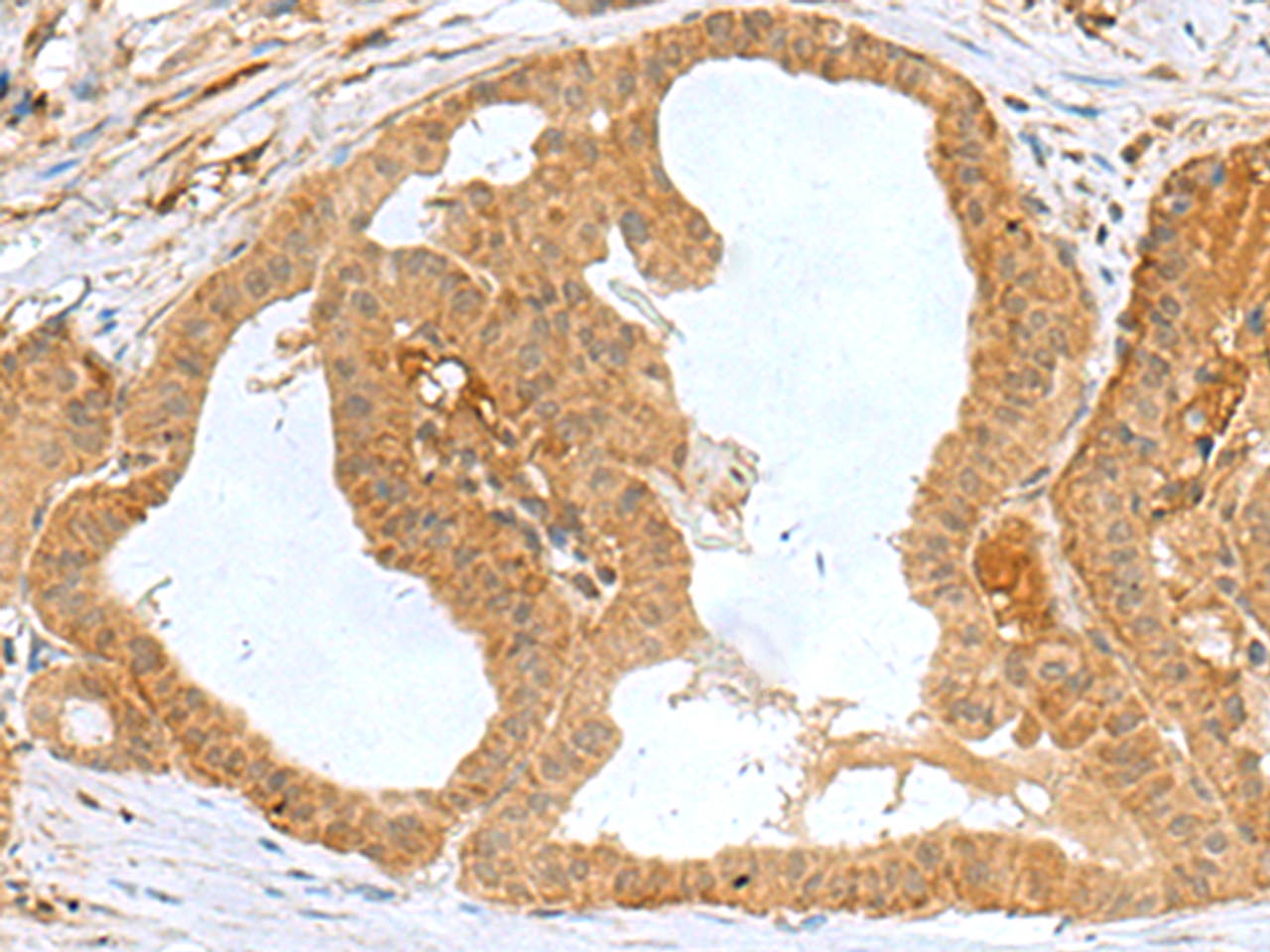 Immunohistochemistry of paraffin-embedded Human thyroid cancer tissue  using MRPS28 Polyclonal Antibody at dilution of 1:60(×200)